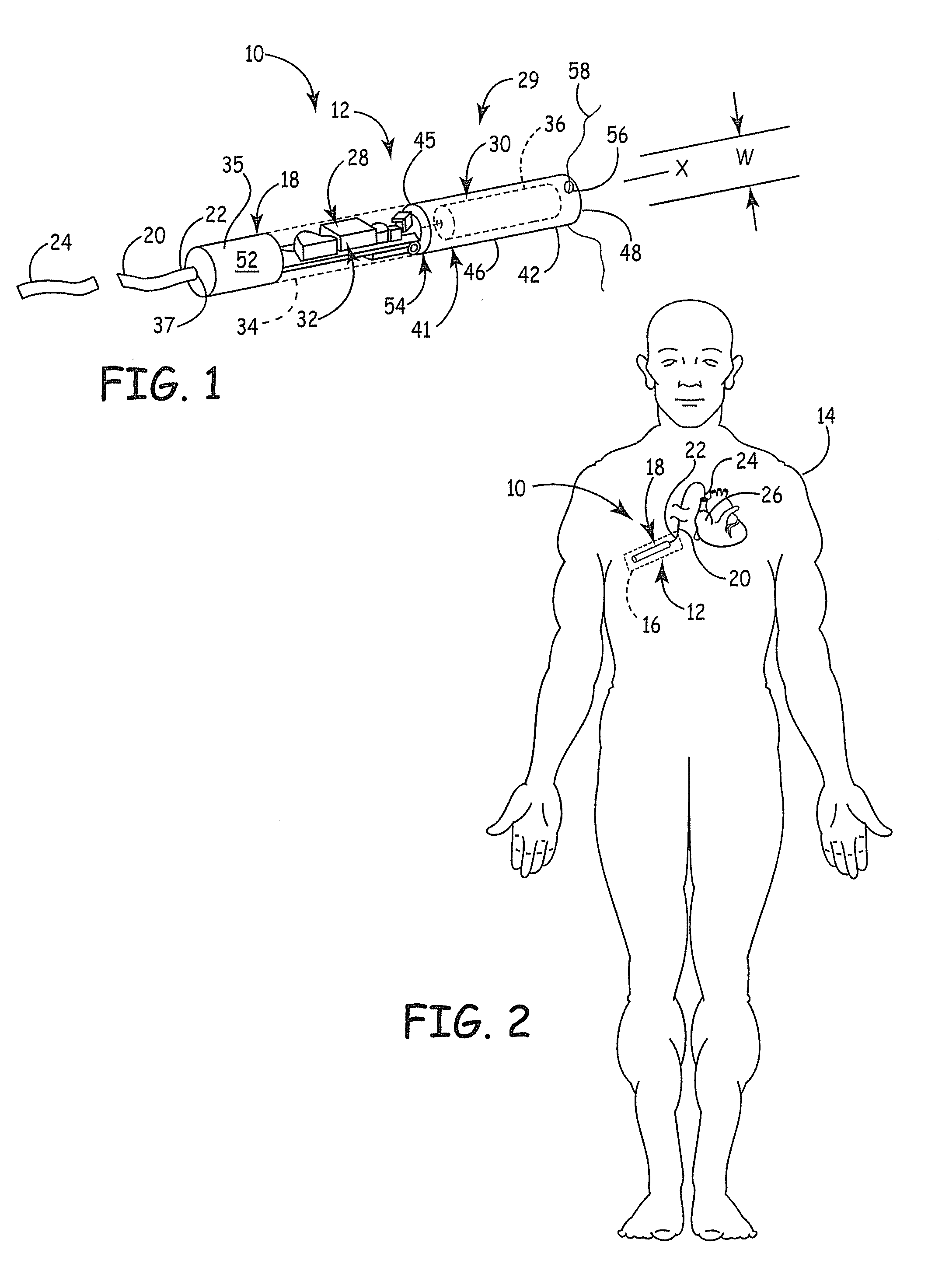 Implantable medical device with exposed generator