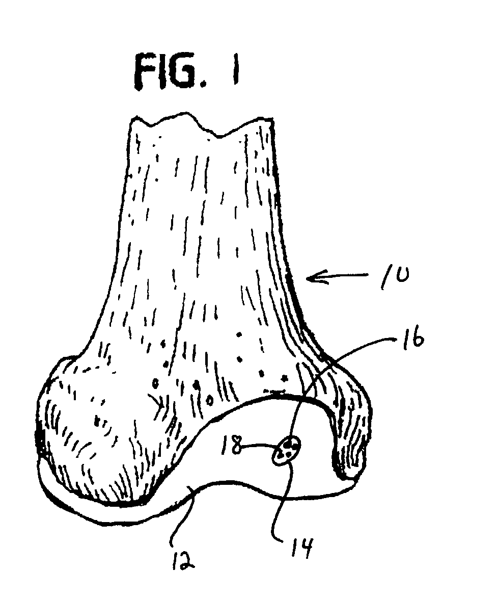 Collagen carrier of therapeutic genetic material, and method