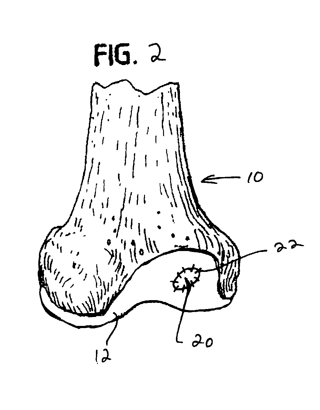 Collagen carrier of therapeutic genetic material, and method