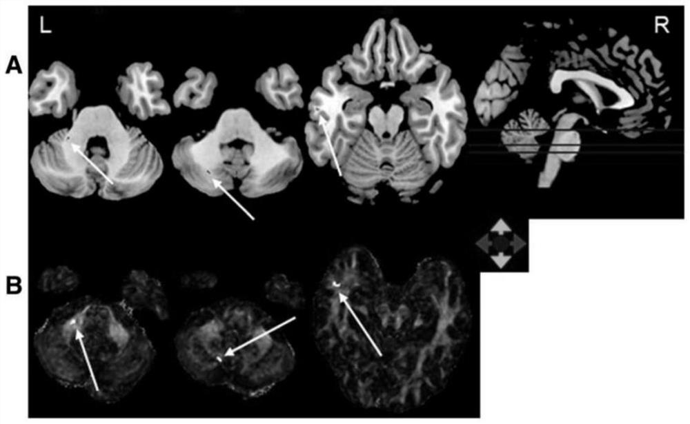 A multimodal molecular imaging approach for radiation-induced brain injury biomarkers