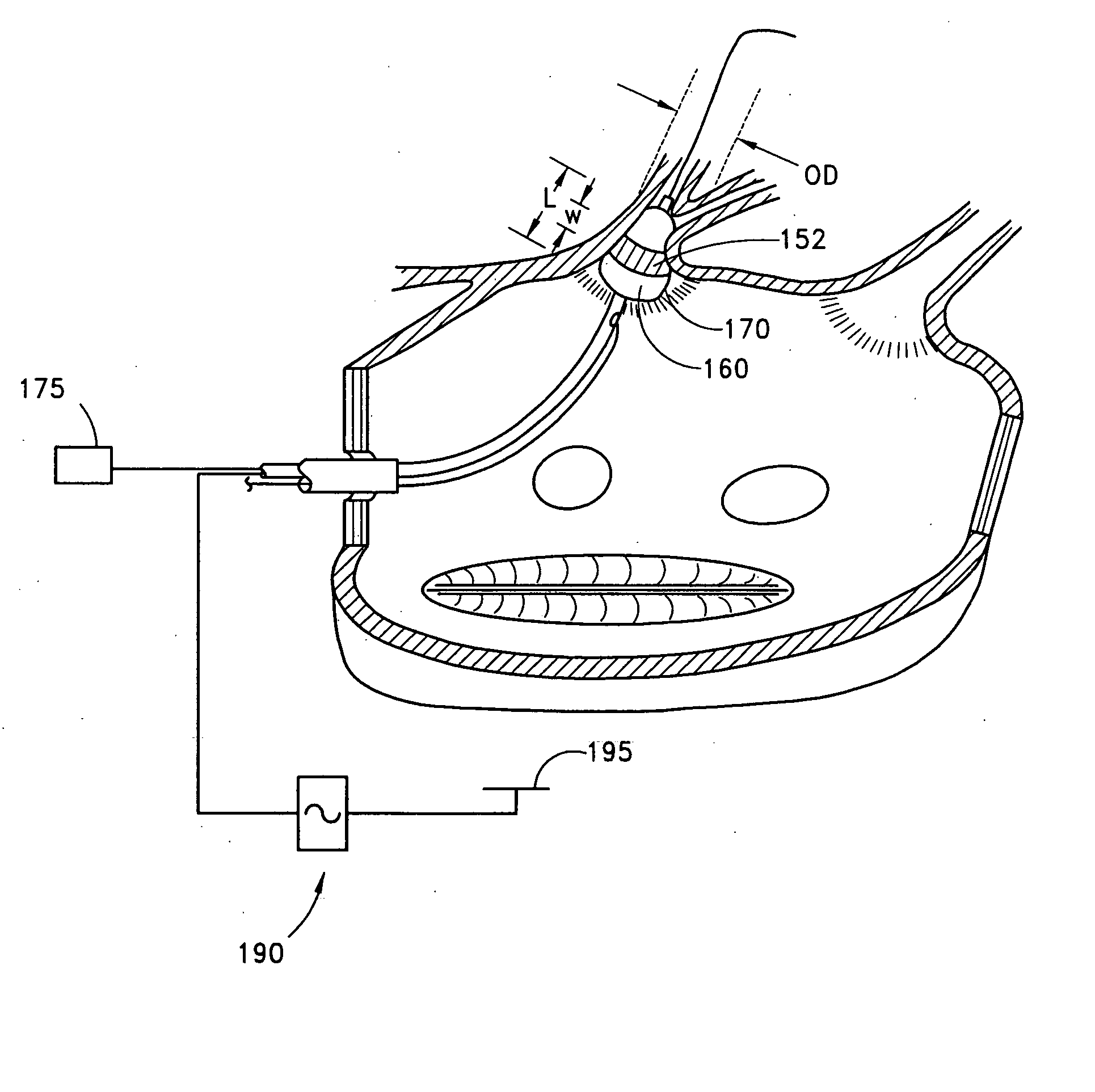 Circumferential ablation device assembly