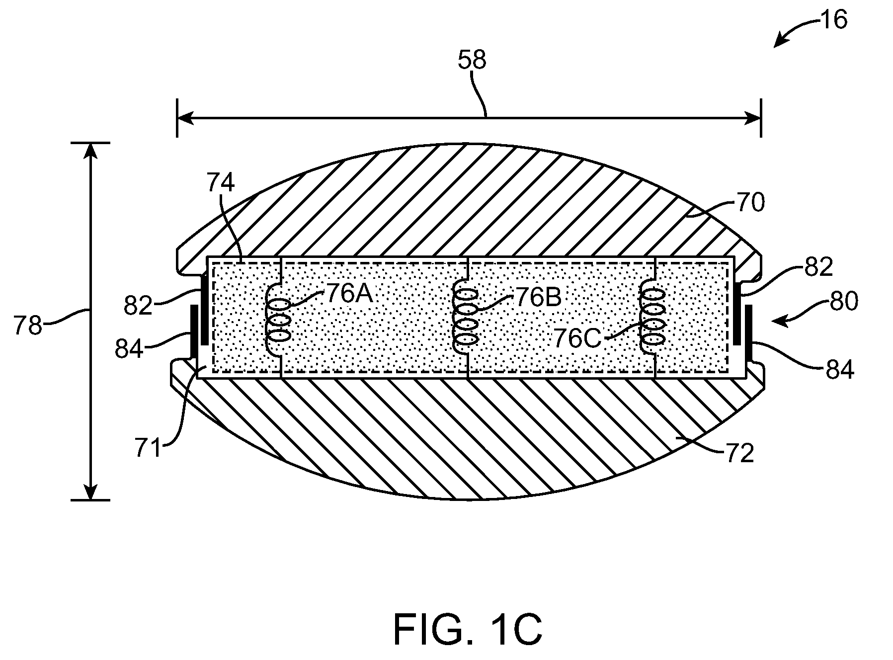 Customized Intervertebral Prosthetic Disc with Shock Absorption