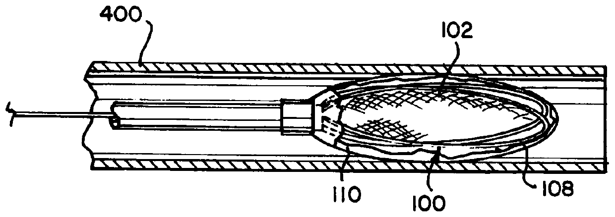 Adhesive cover occluding device for aneurysm treatment