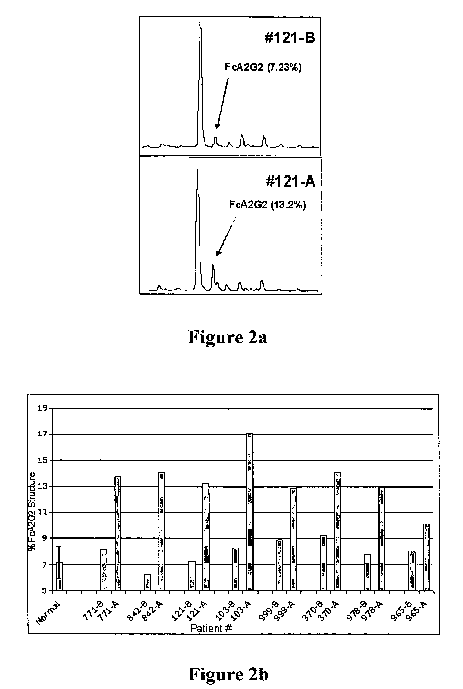 Diagnosis of liver pathology through assessment of protein glycosylation