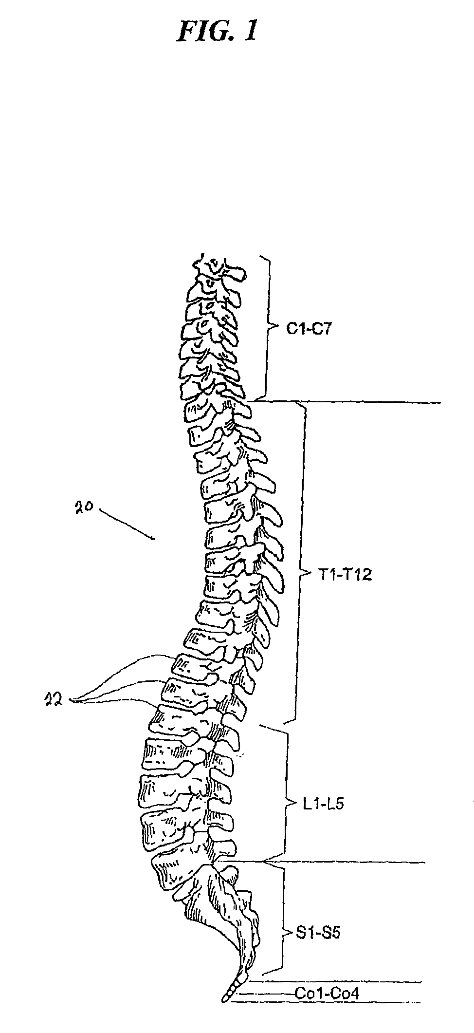 Articulating facet fusion screw