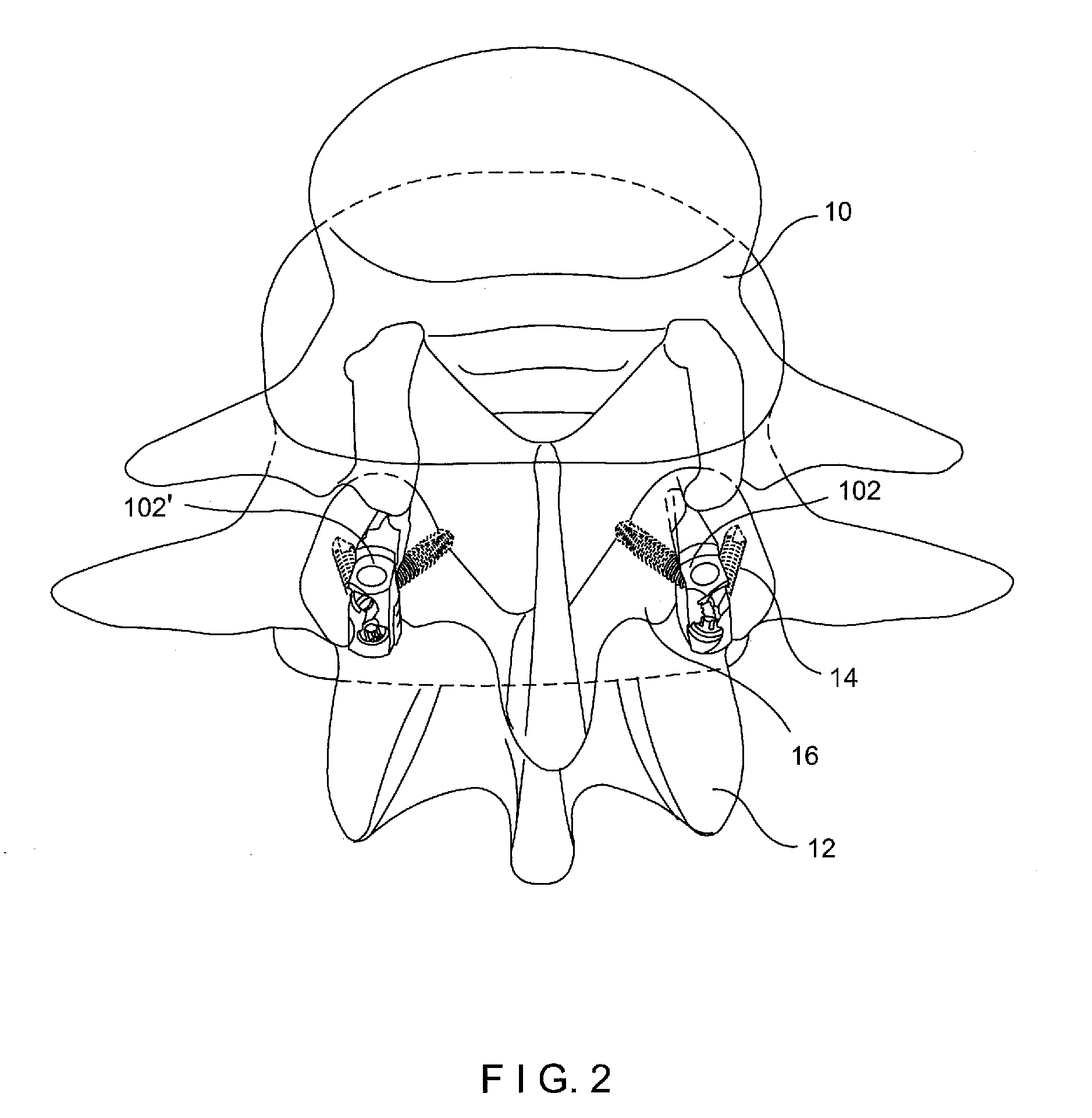 Facet interference cage