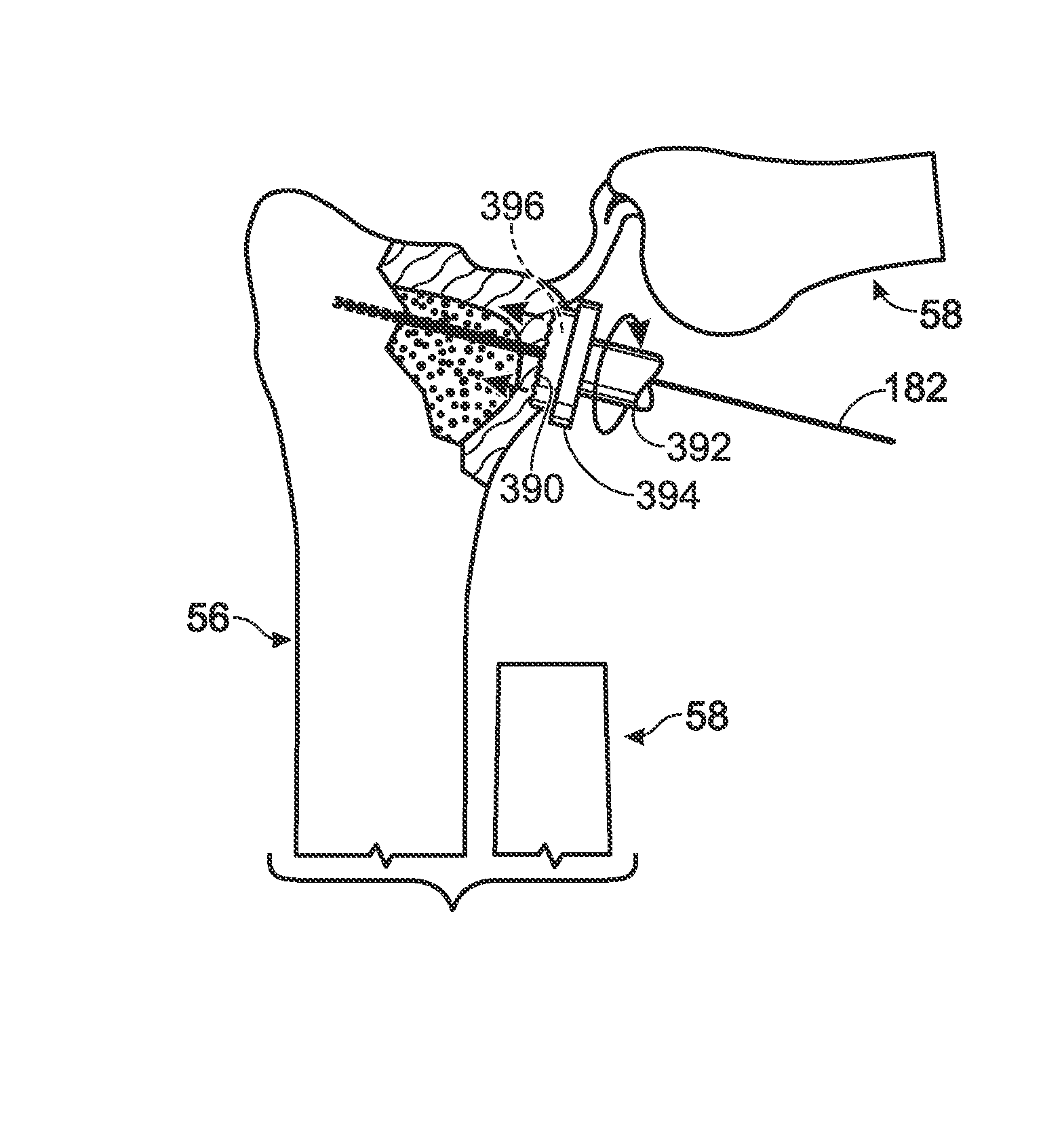 Partial or complete prosthetic replacement arthroplasty of the distal radioulnar joint