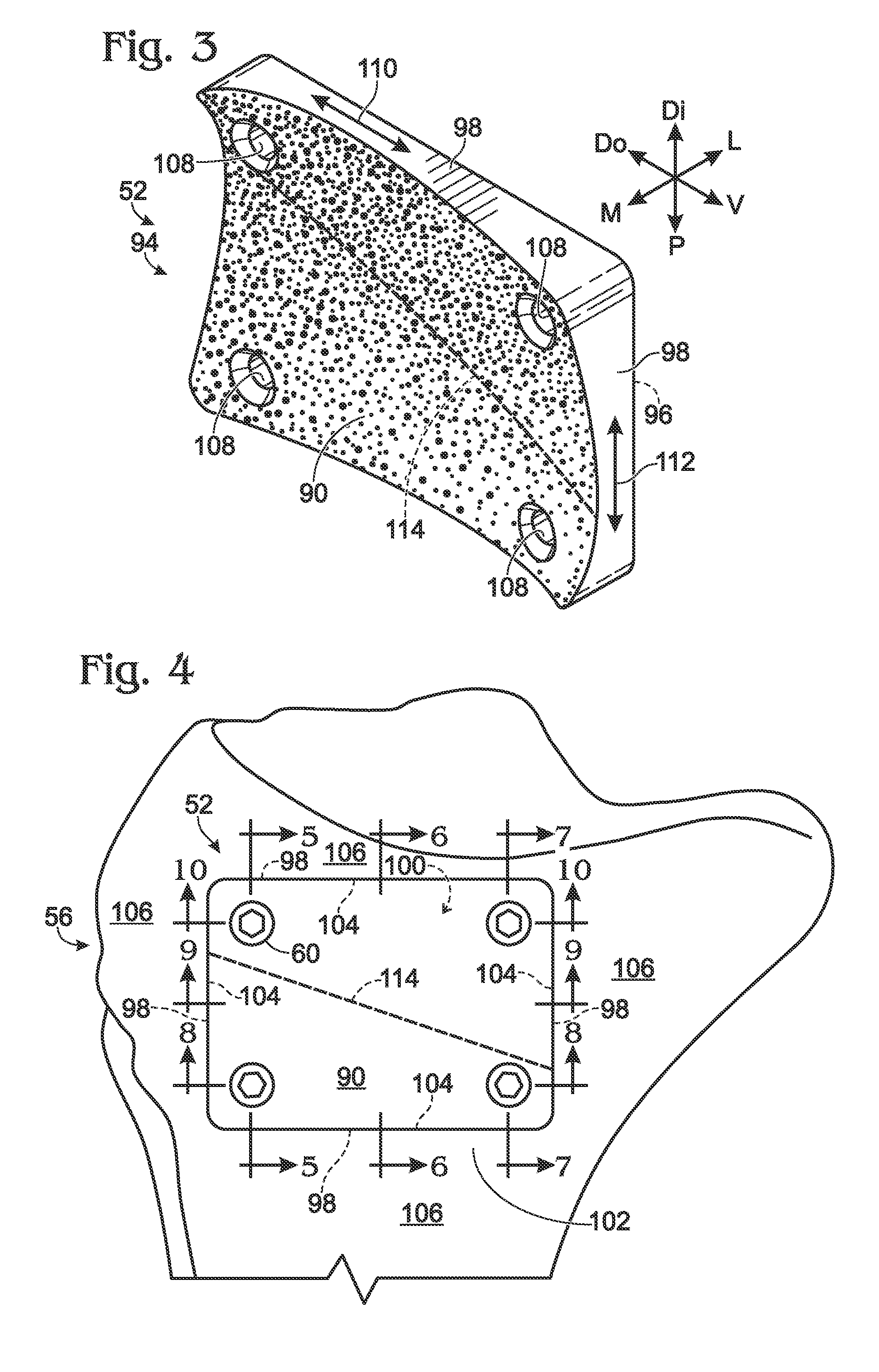 Partial or complete prosthetic replacement arthroplasty of the distal radioulnar joint