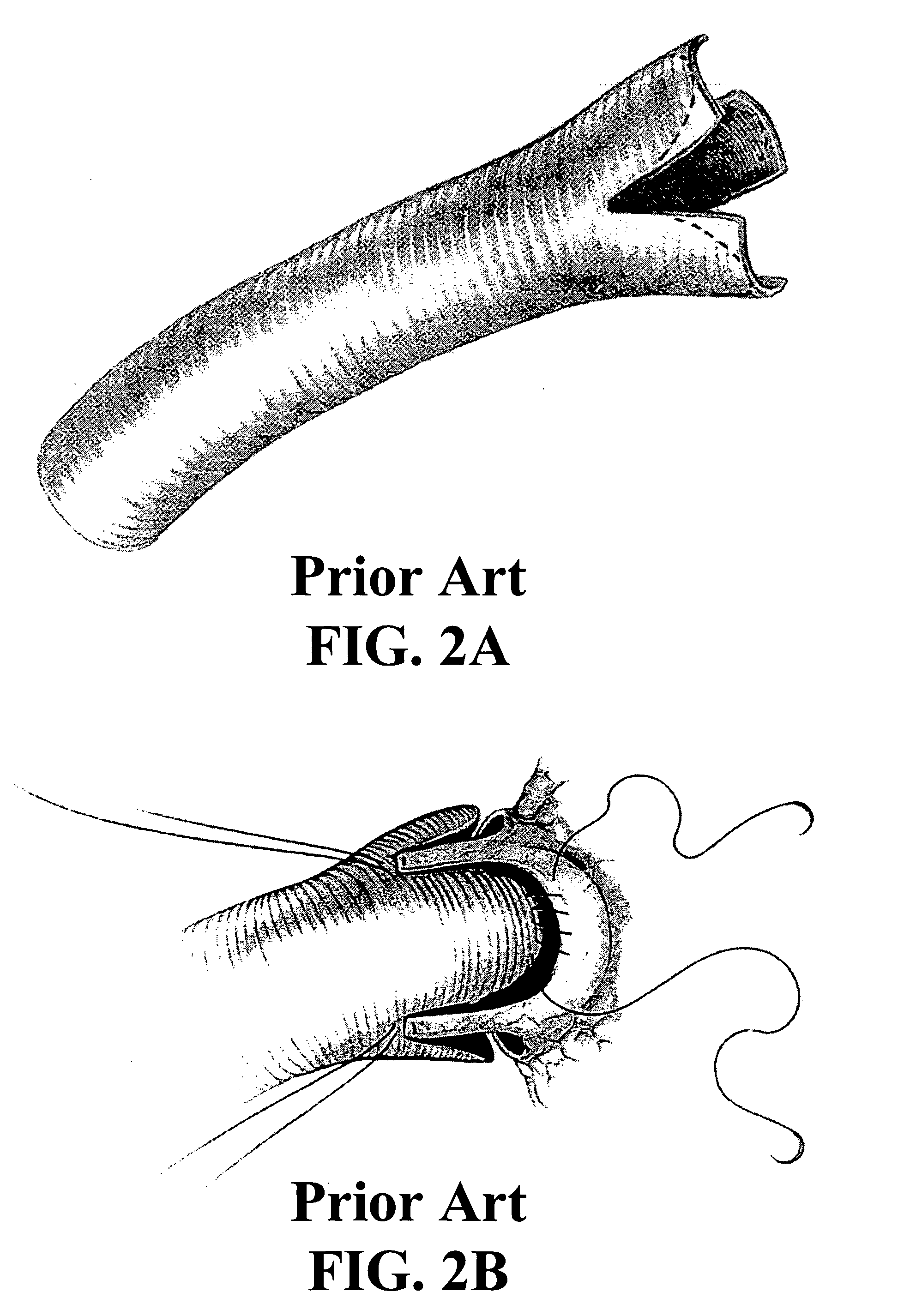 Cone-shaped aortic root replacement graft and methods for making and using same