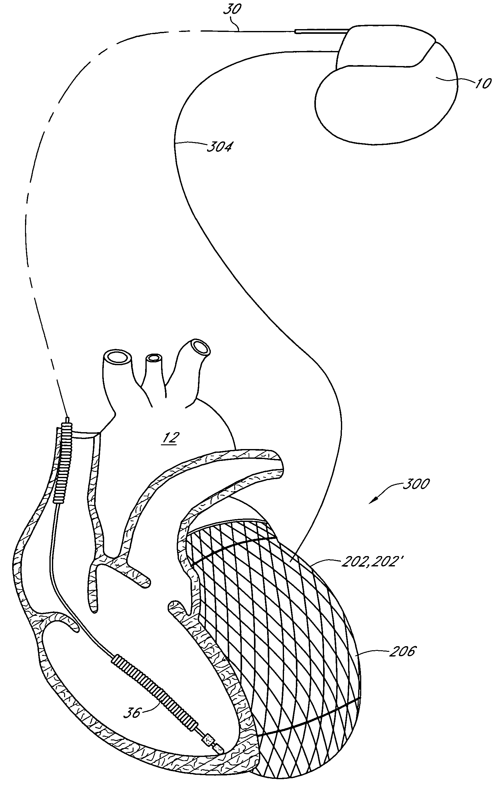 Cardiac constraint/therapeutic stimulation device