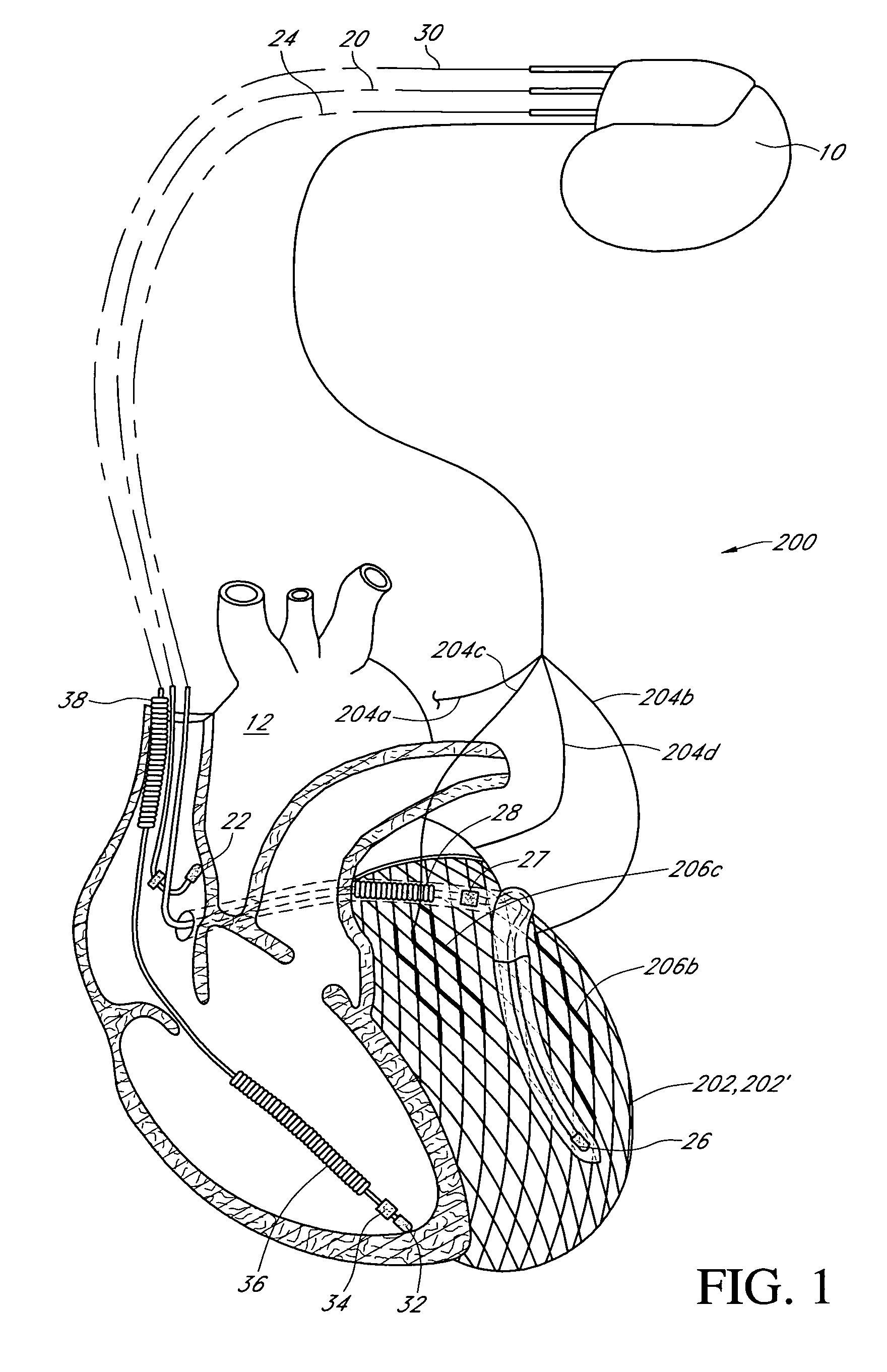 Cardiac constraint/therapeutic stimulation device