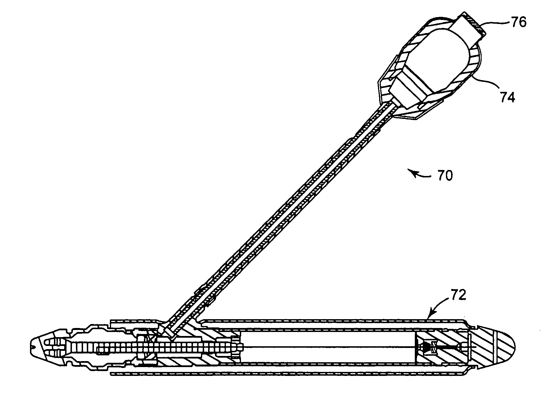 Implantable fluid transfer system