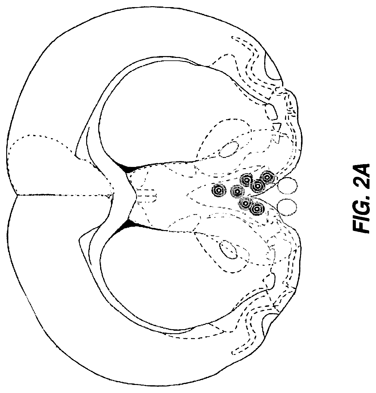 Gene therapy for neurometabolic disorders