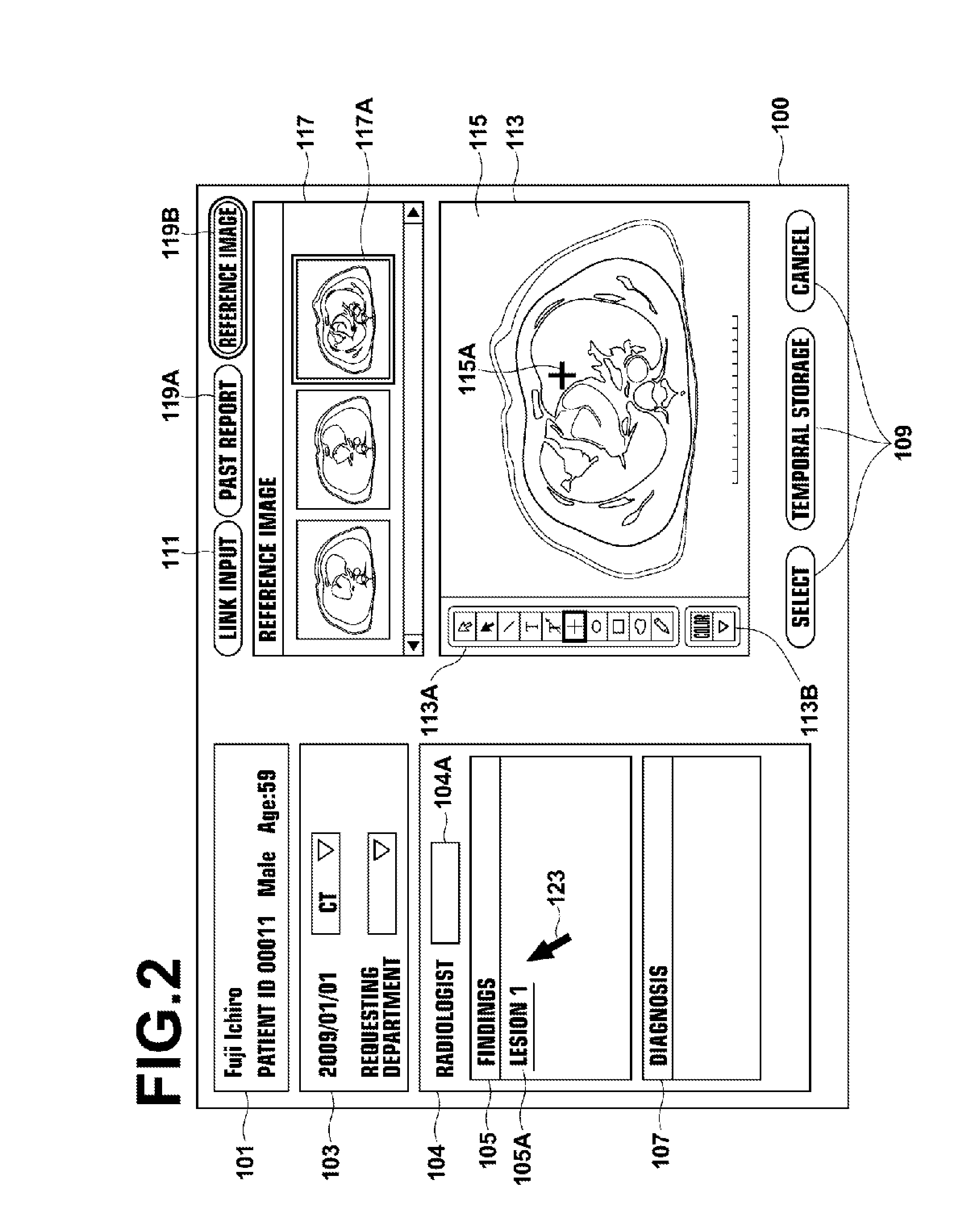 Lesion area extraction apparatus, method, and program