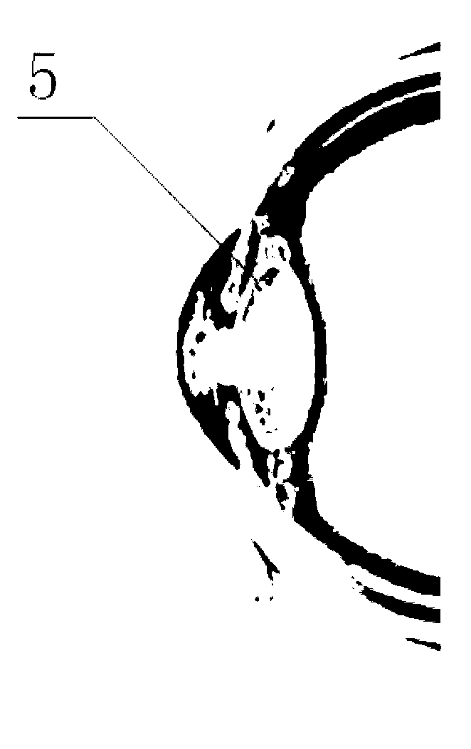 Device for preventing and treating posterior capsule opacification