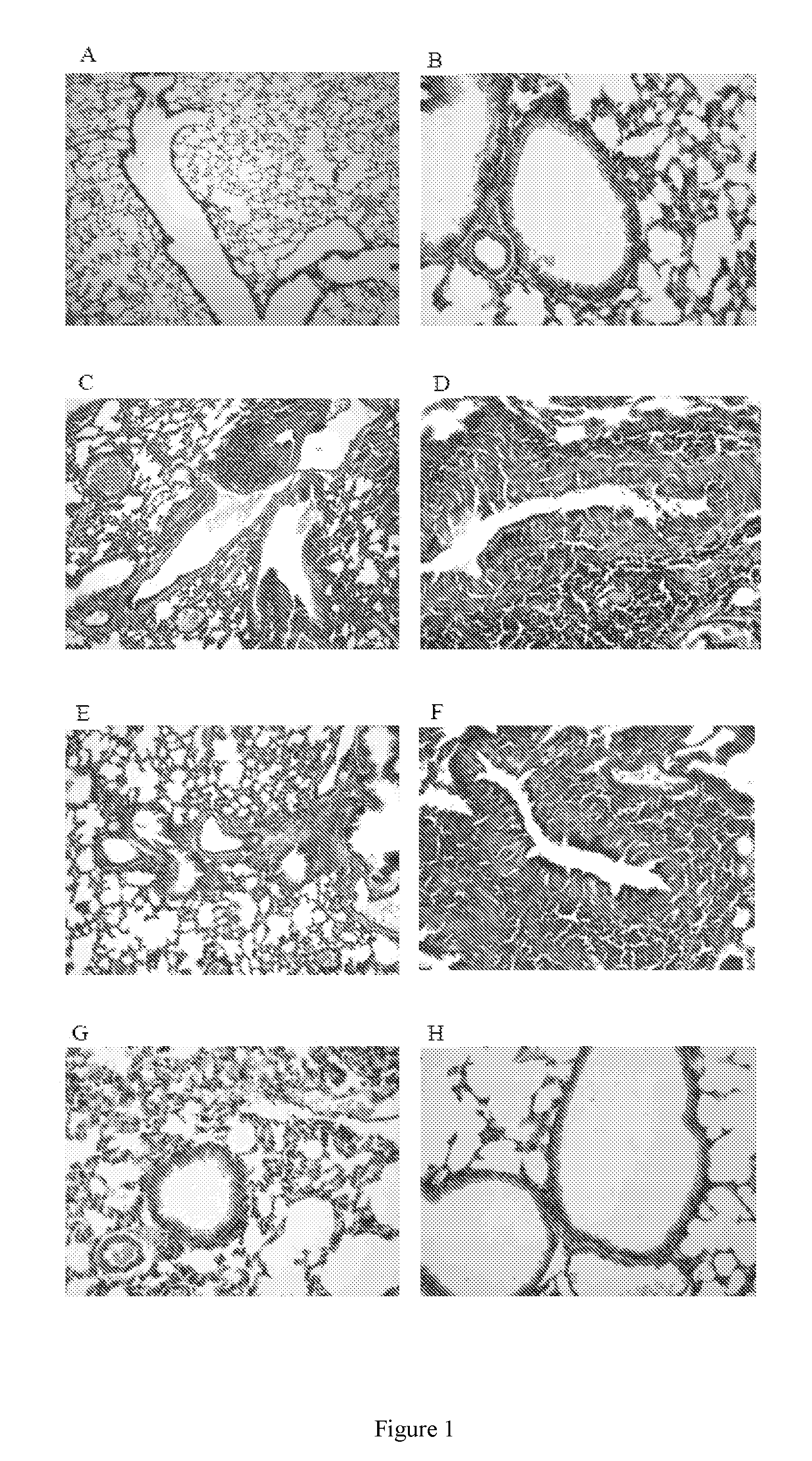 Vaccine for prophylaxis or treatment of an allergen-driven airway pathology