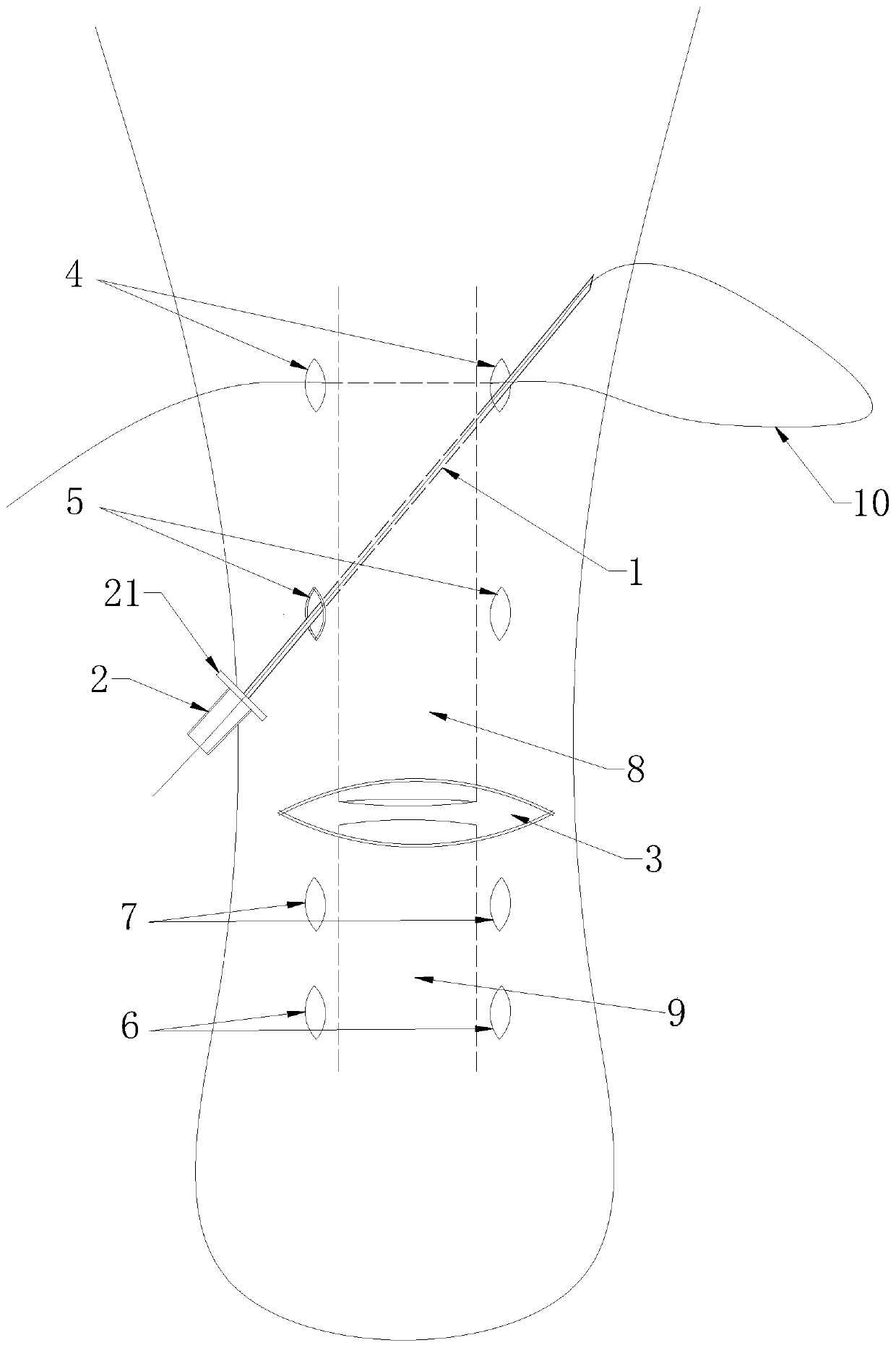 Minimally invasive treatment auxiliary device for occlusive achilles tendon rupture and use method of device