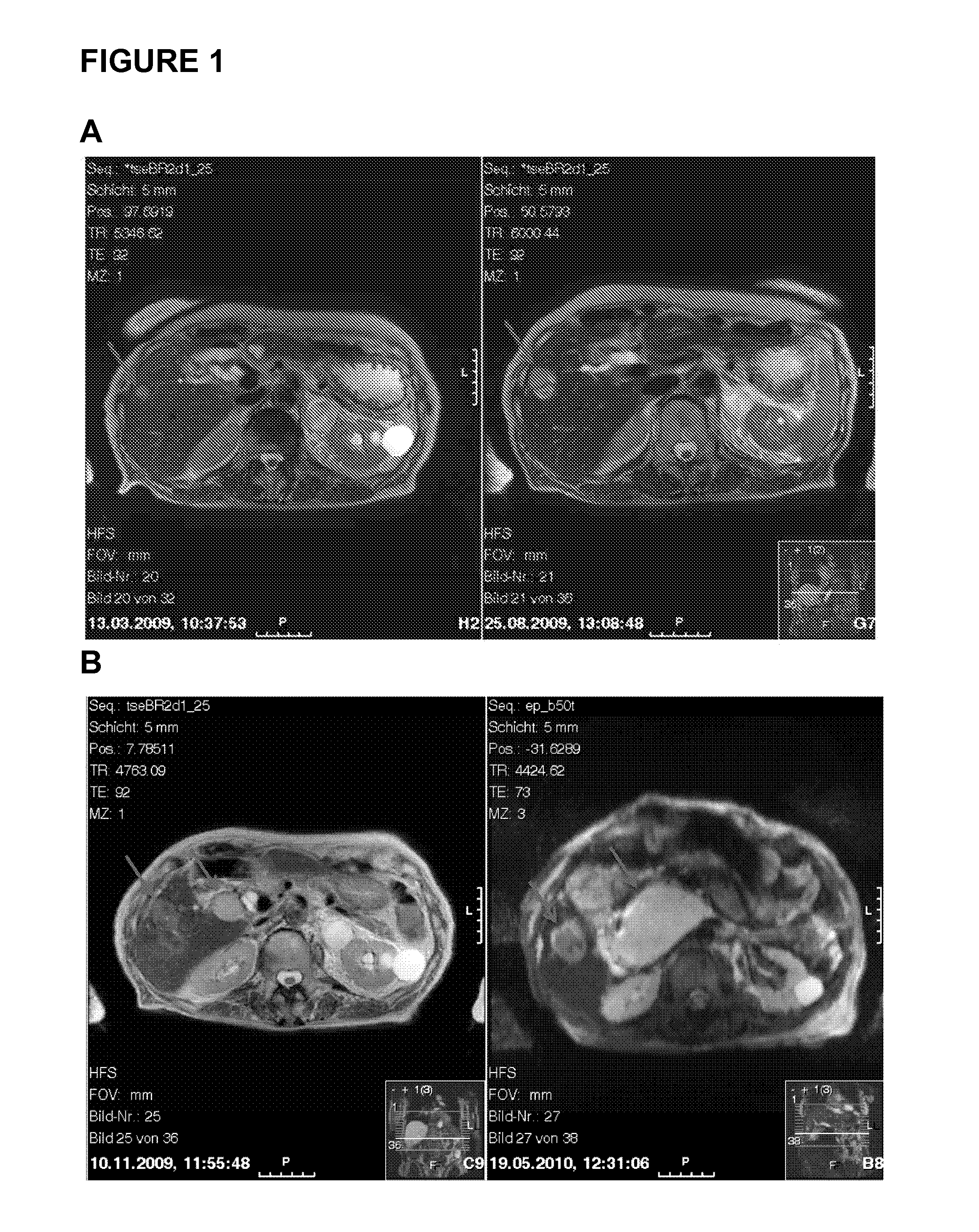 Methods and compositions for diagnosing gastrointestinal stromal tumors