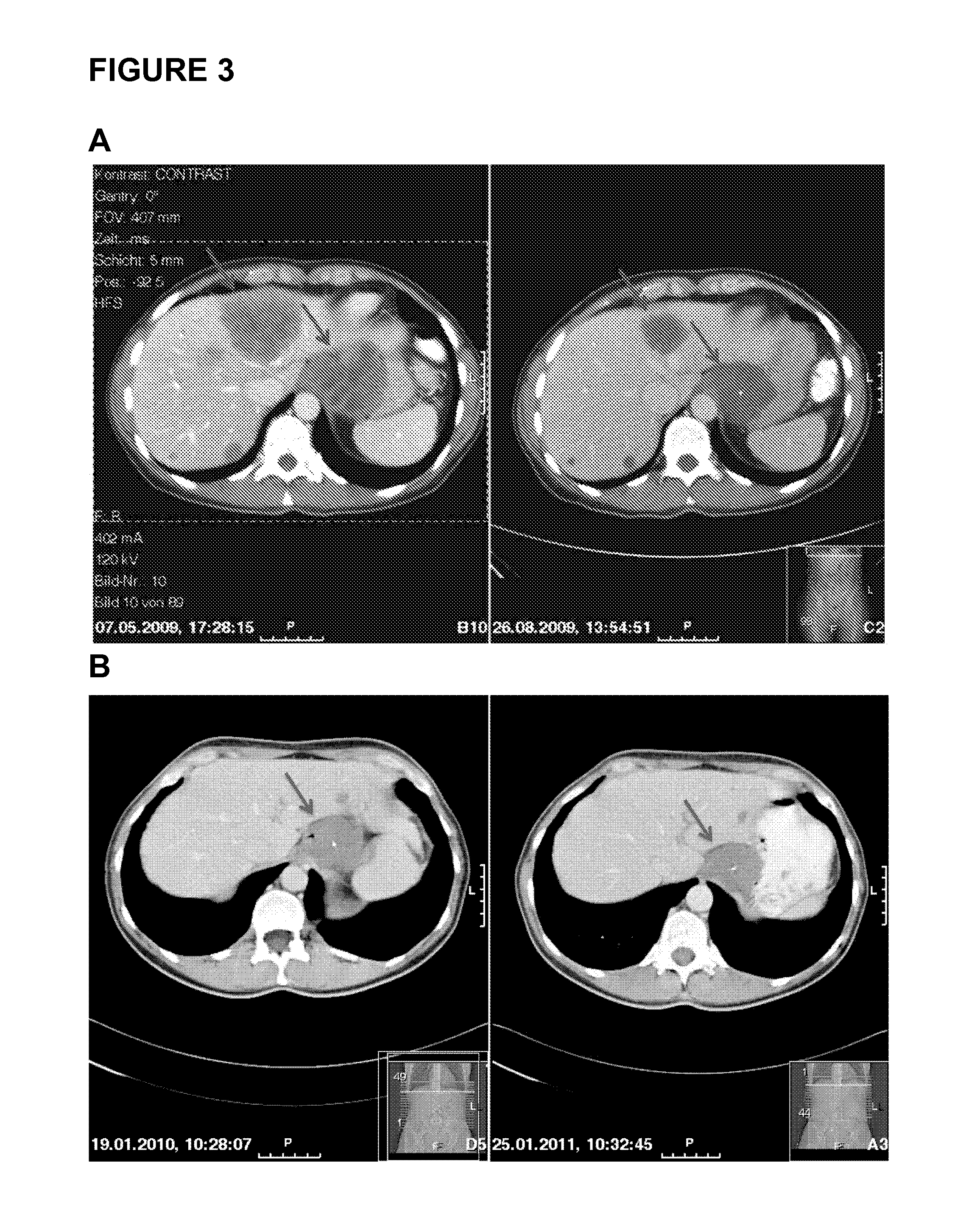 Methods and compositions for diagnosing gastrointestinal stromal tumors