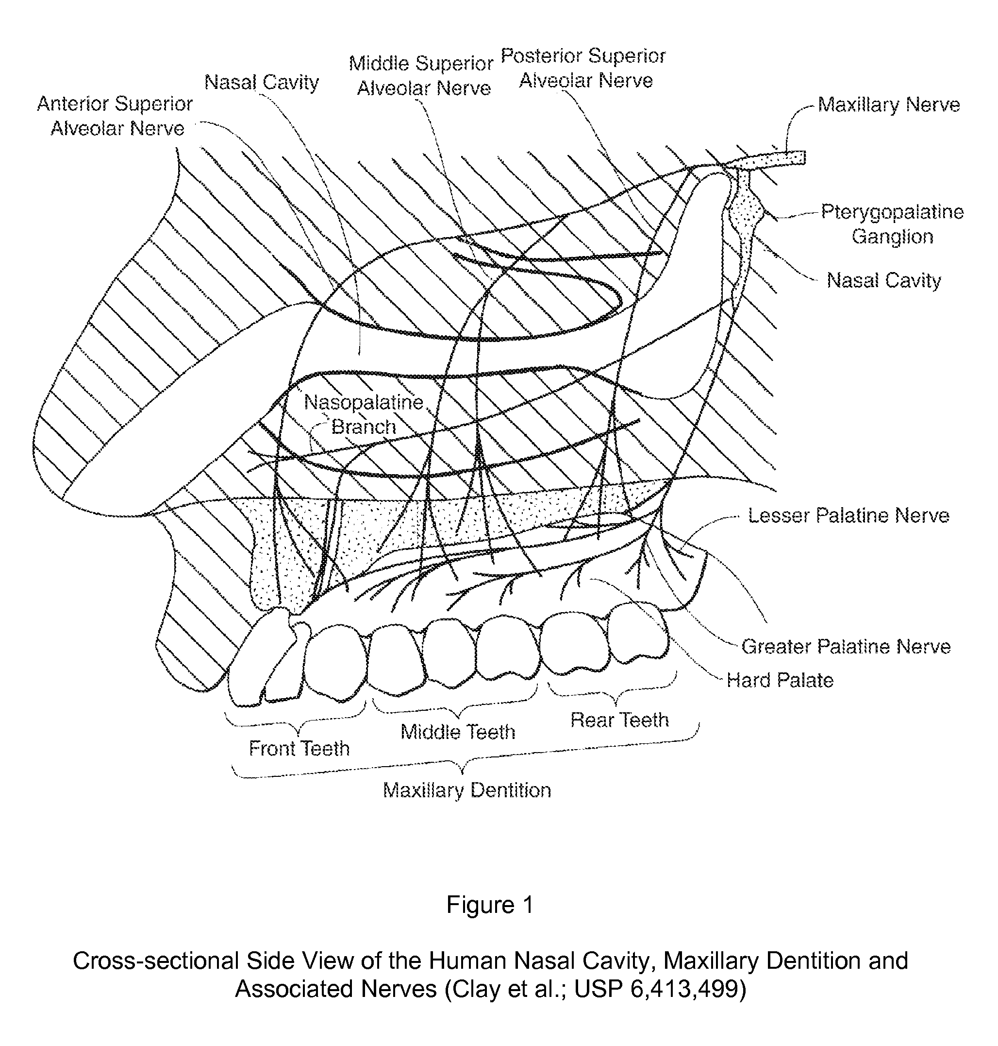 Dental anesthetic comprising tetracaine and a vasoconstrictor for intranasal administration