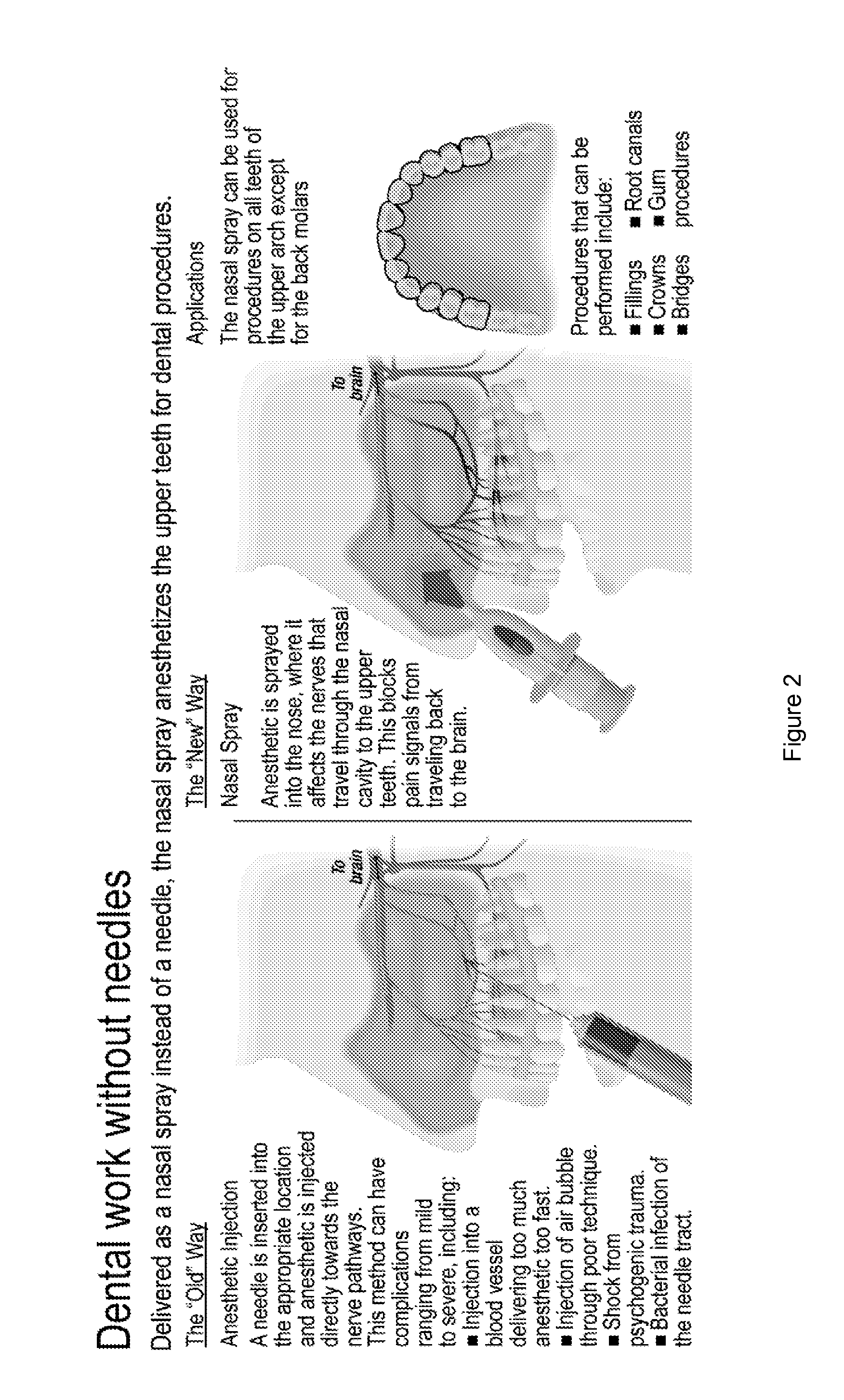 Dental anesthetic comprising tetracaine and a vasoconstrictor for intranasal administration