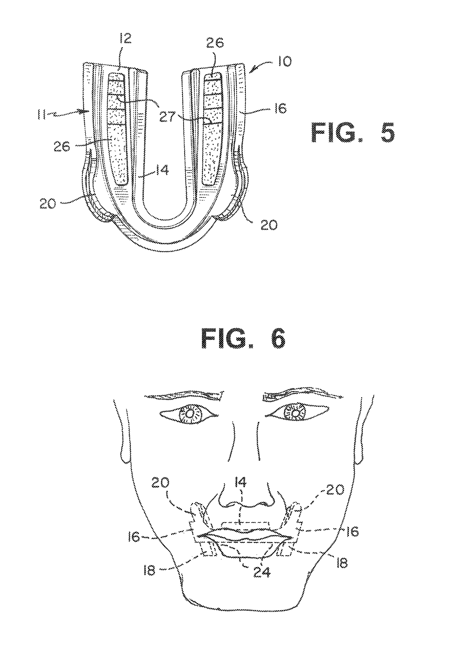 Dental appliance and method of fitting