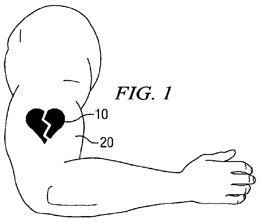 Tattoo removal system and method