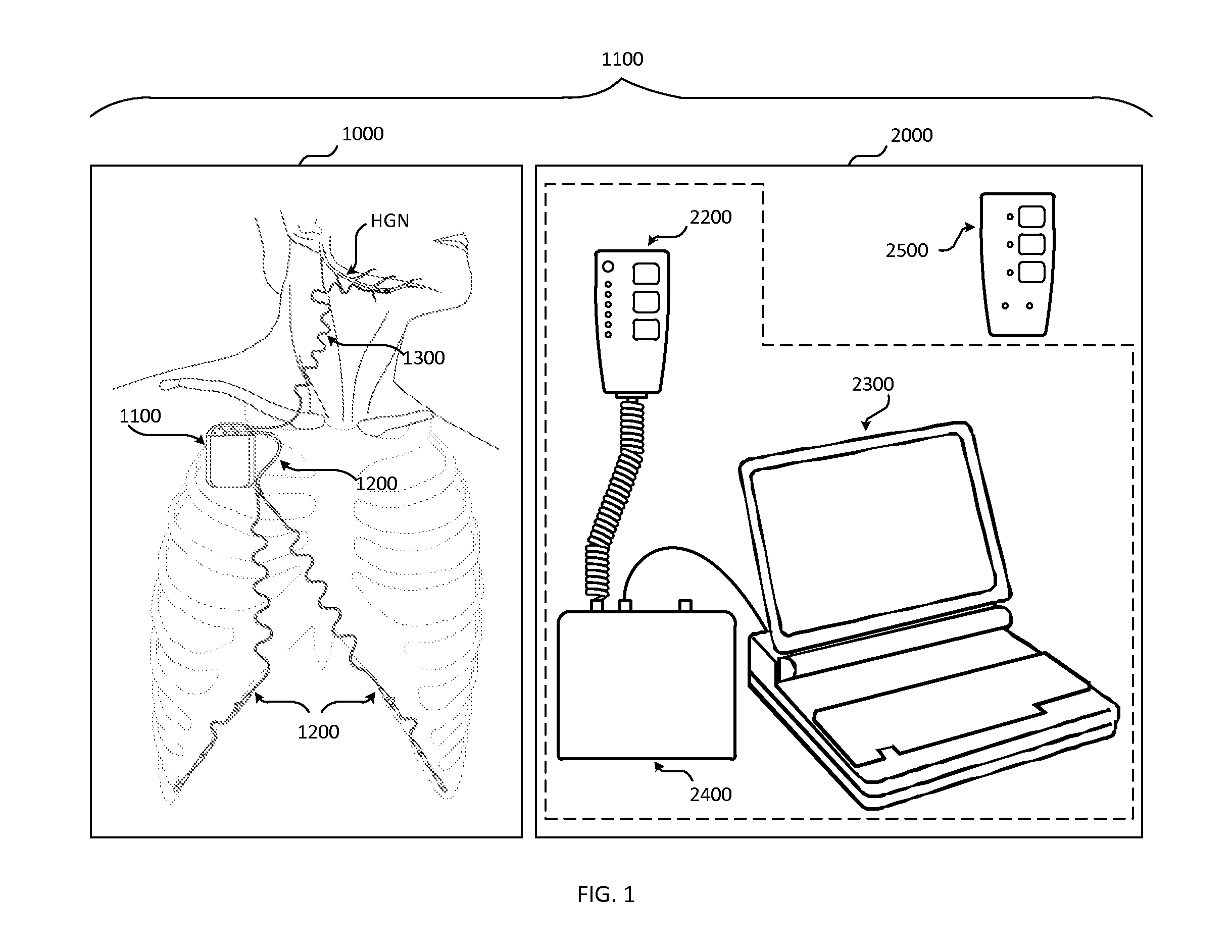 Obstructive sleep apnea treatment devices, systems and methods