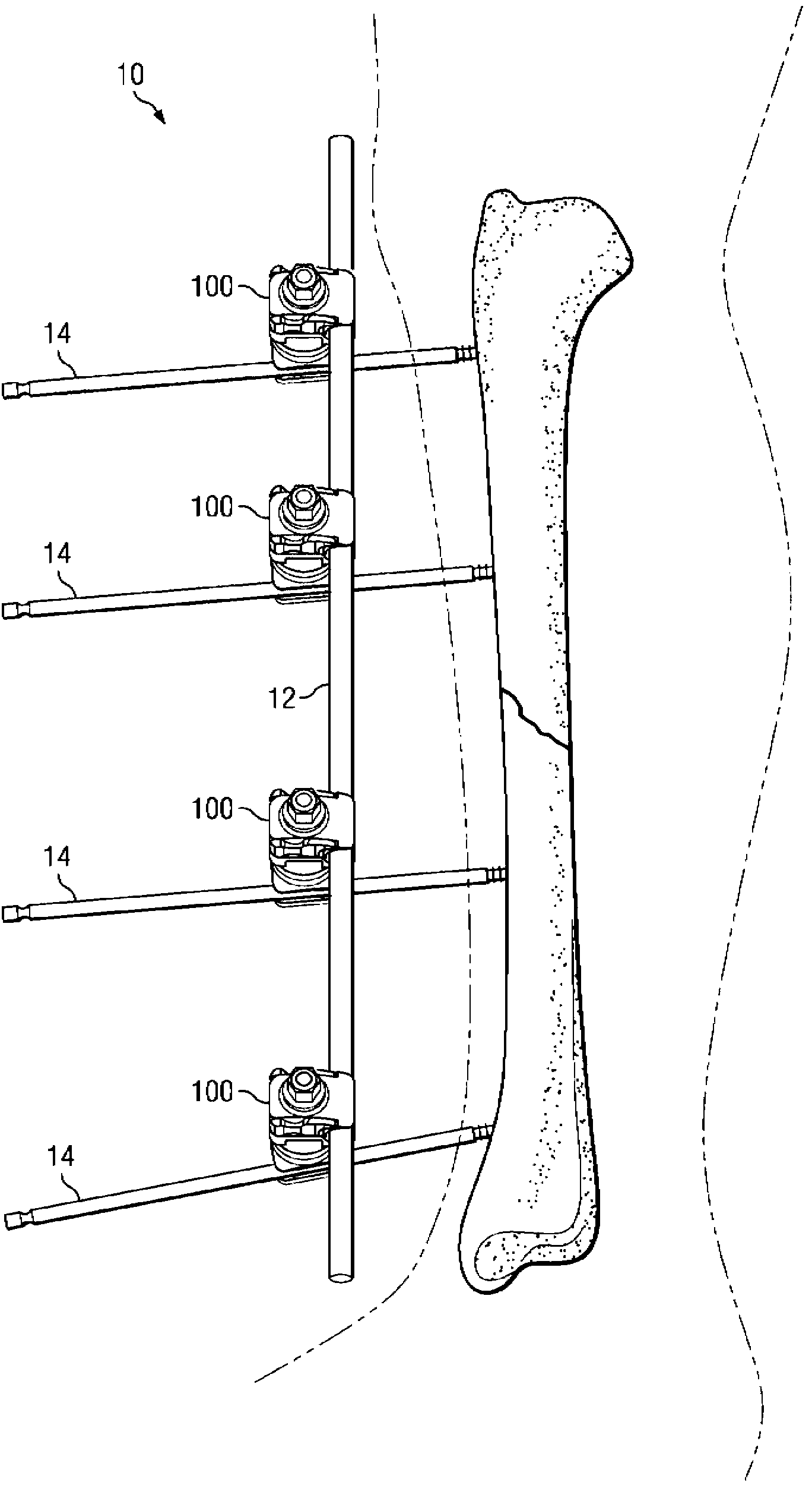 Multi-locking external fixation clamp