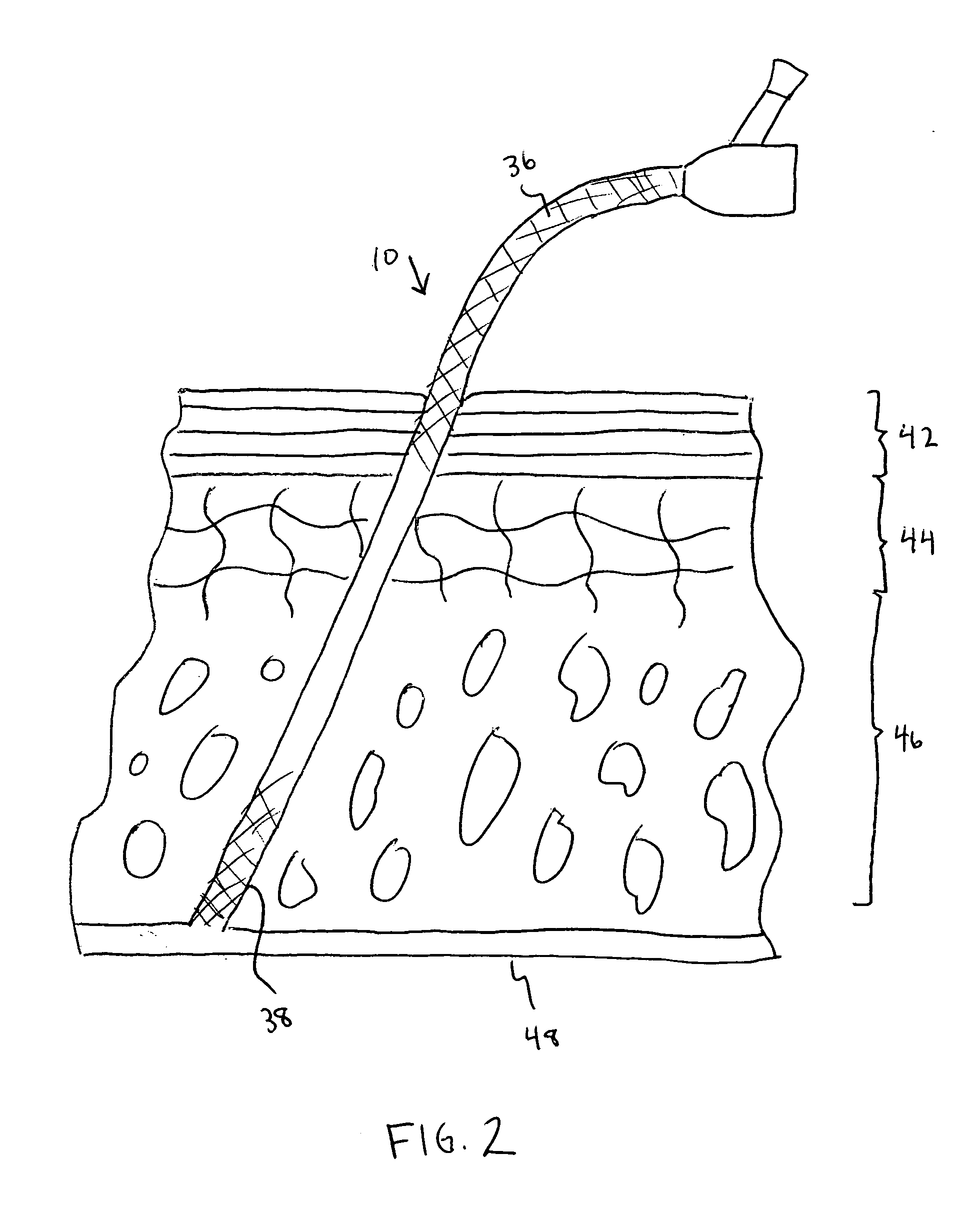 Catheter with polymeric coating