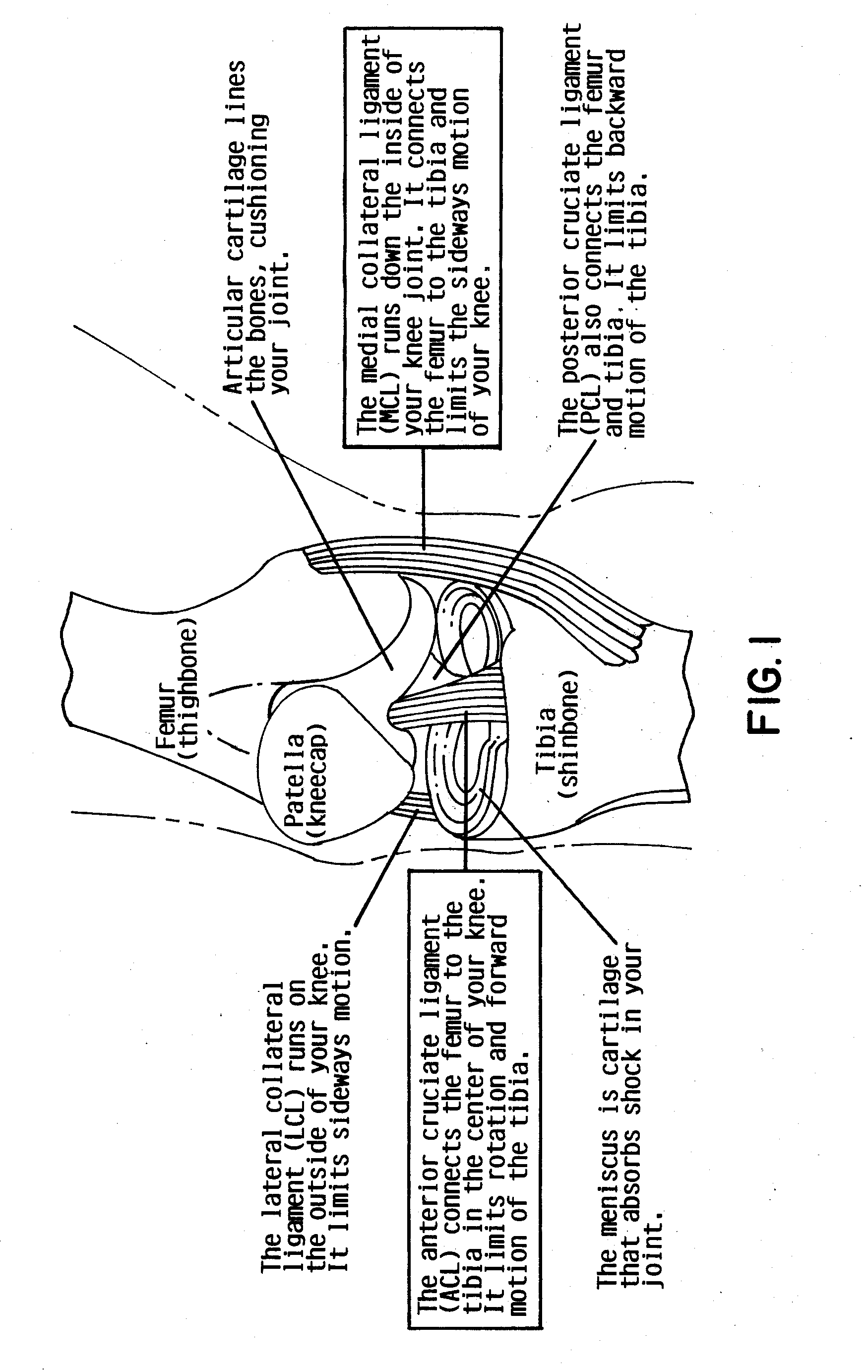 Low friction resurfacing implant