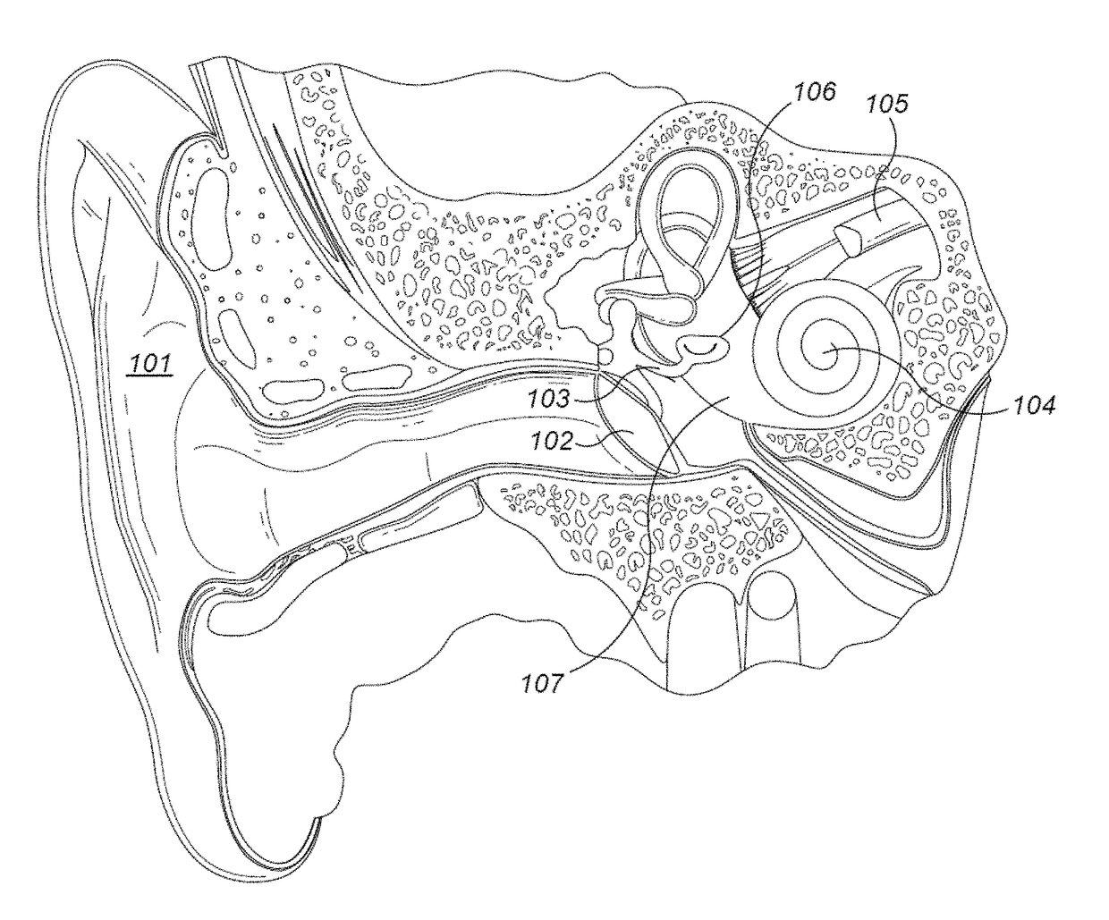 Fixation of a Bone Conduction Floating Mass Transducer