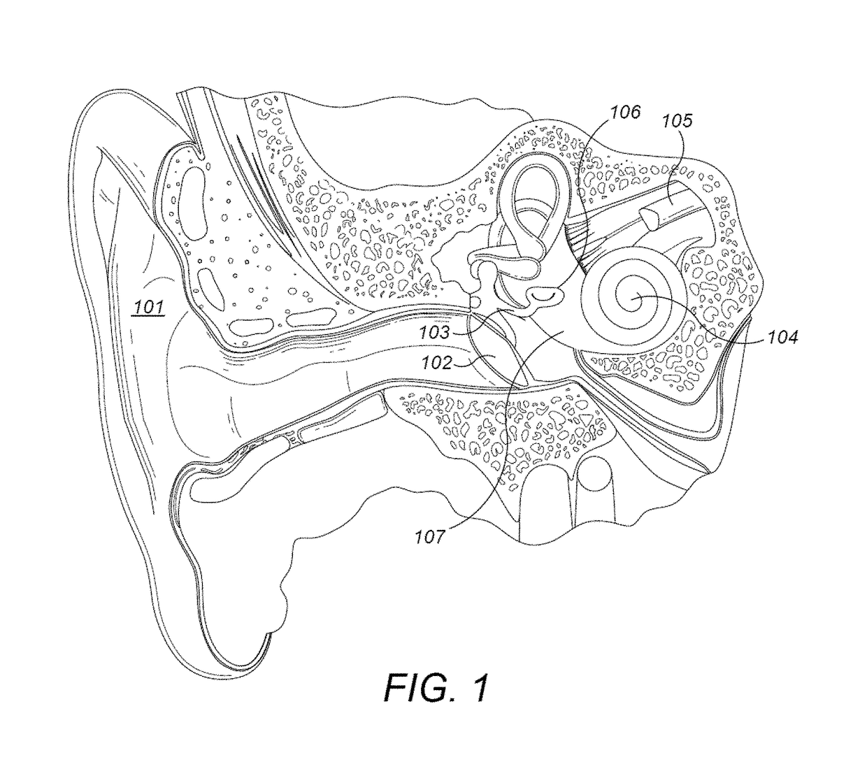 Fixation of a Bone Conduction Floating Mass Transducer