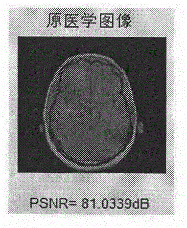 DWT-DCT (Discrete Wavelet Transform-Discrete Cosine Transform) and Logistic Map-based medical image robust watermarking method