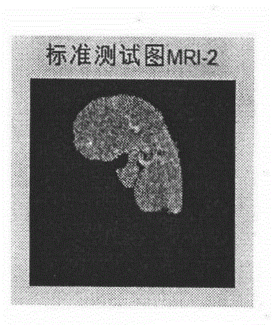 DWT-DCT (Discrete Wavelet Transform-Discrete Cosine Transform) and Logistic Map-based medical image robust watermarking method