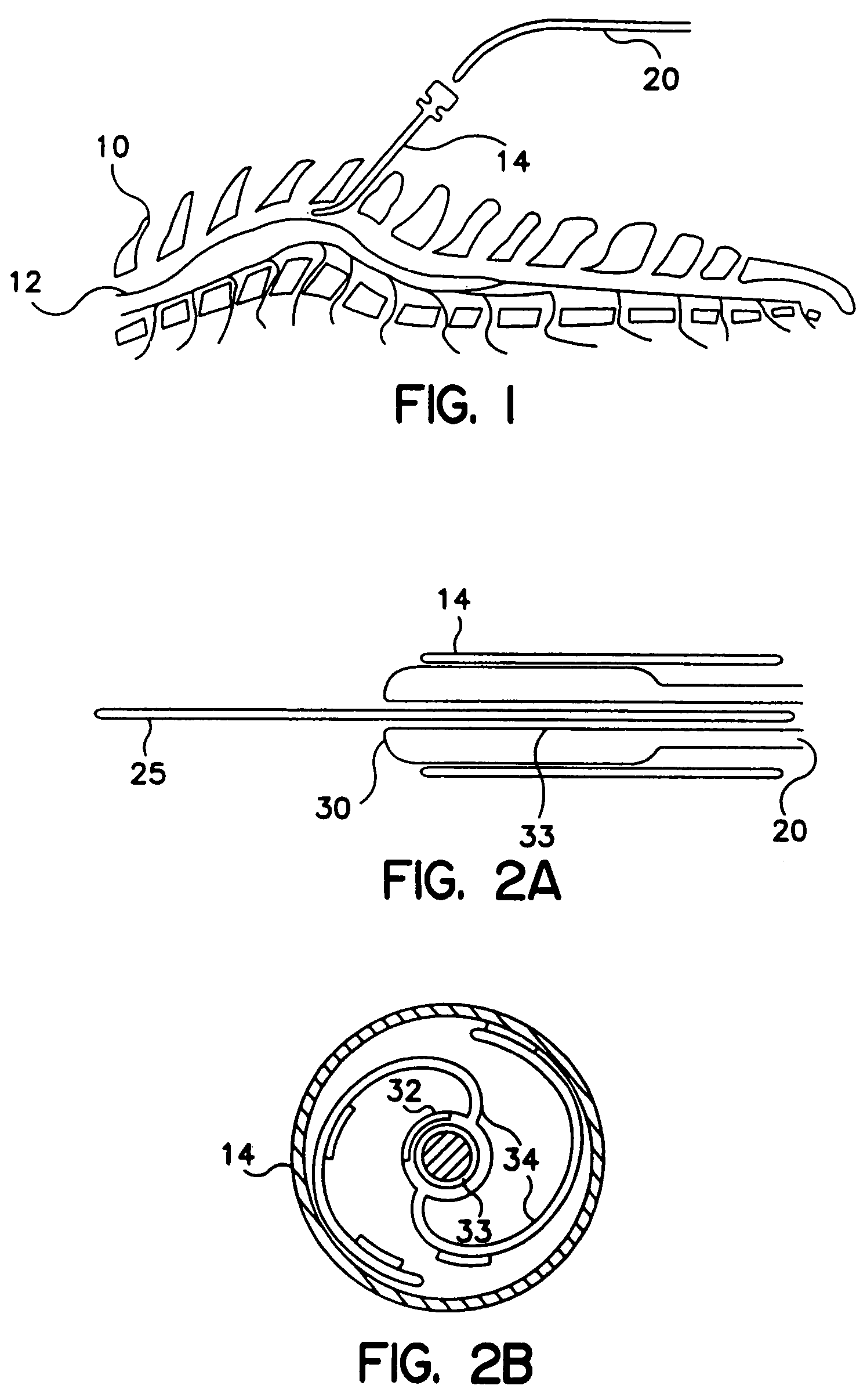 Apparatus and method for expanding a stimulation lead body in situ