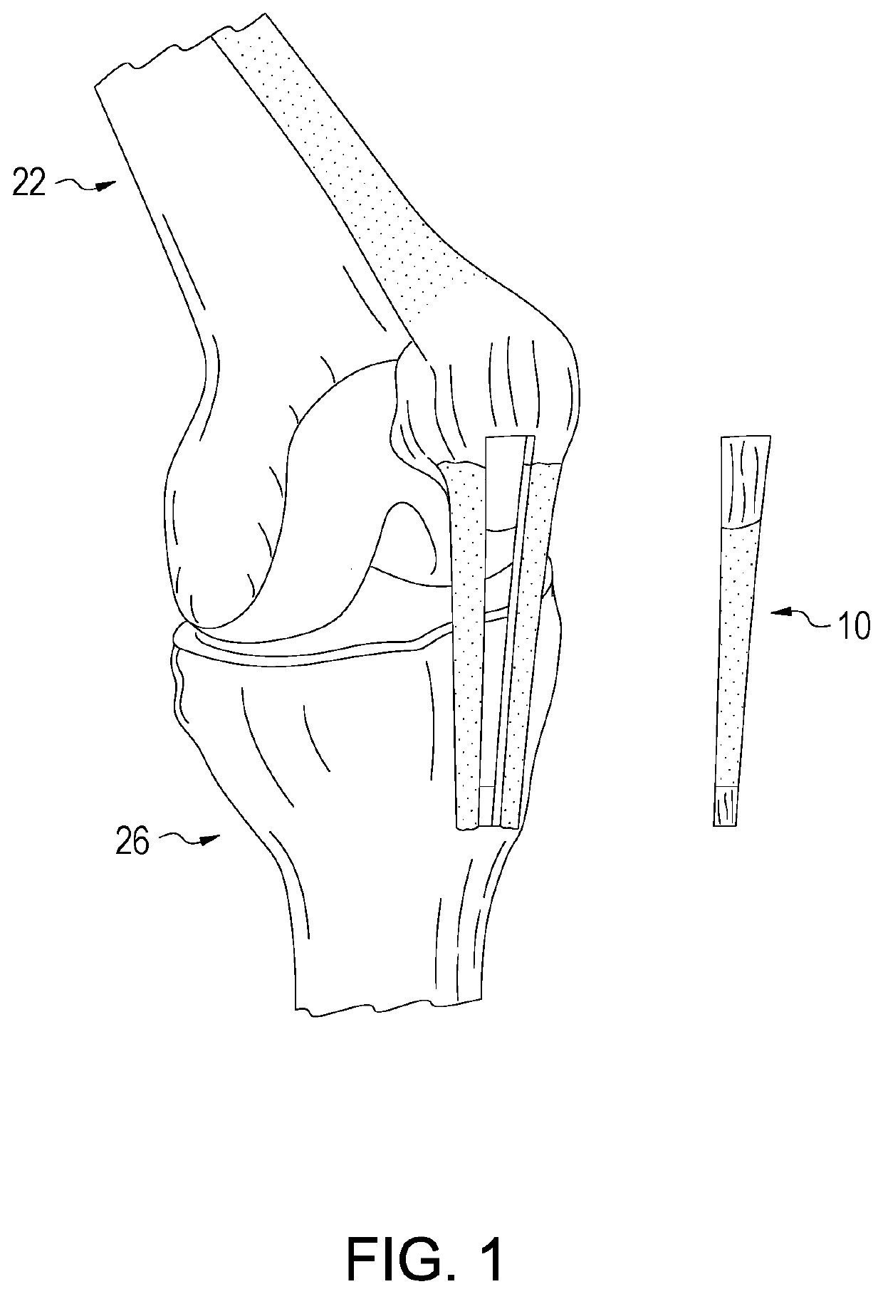 Patellar tendon graft and anterior cruciate ligament (ACL) reconstruction method using suture tape augmentation