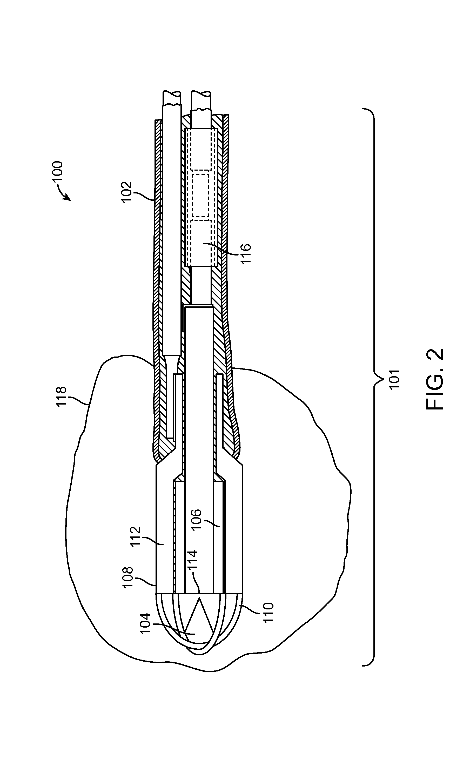 Lithotripsy eye treatment