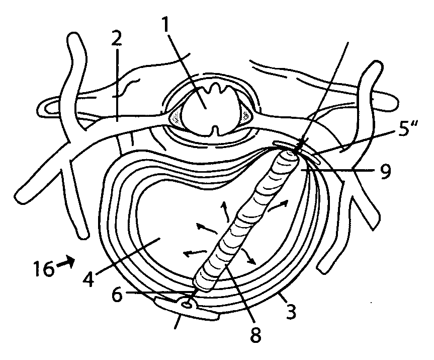 System and devices for the repair of a vertebral disc defect