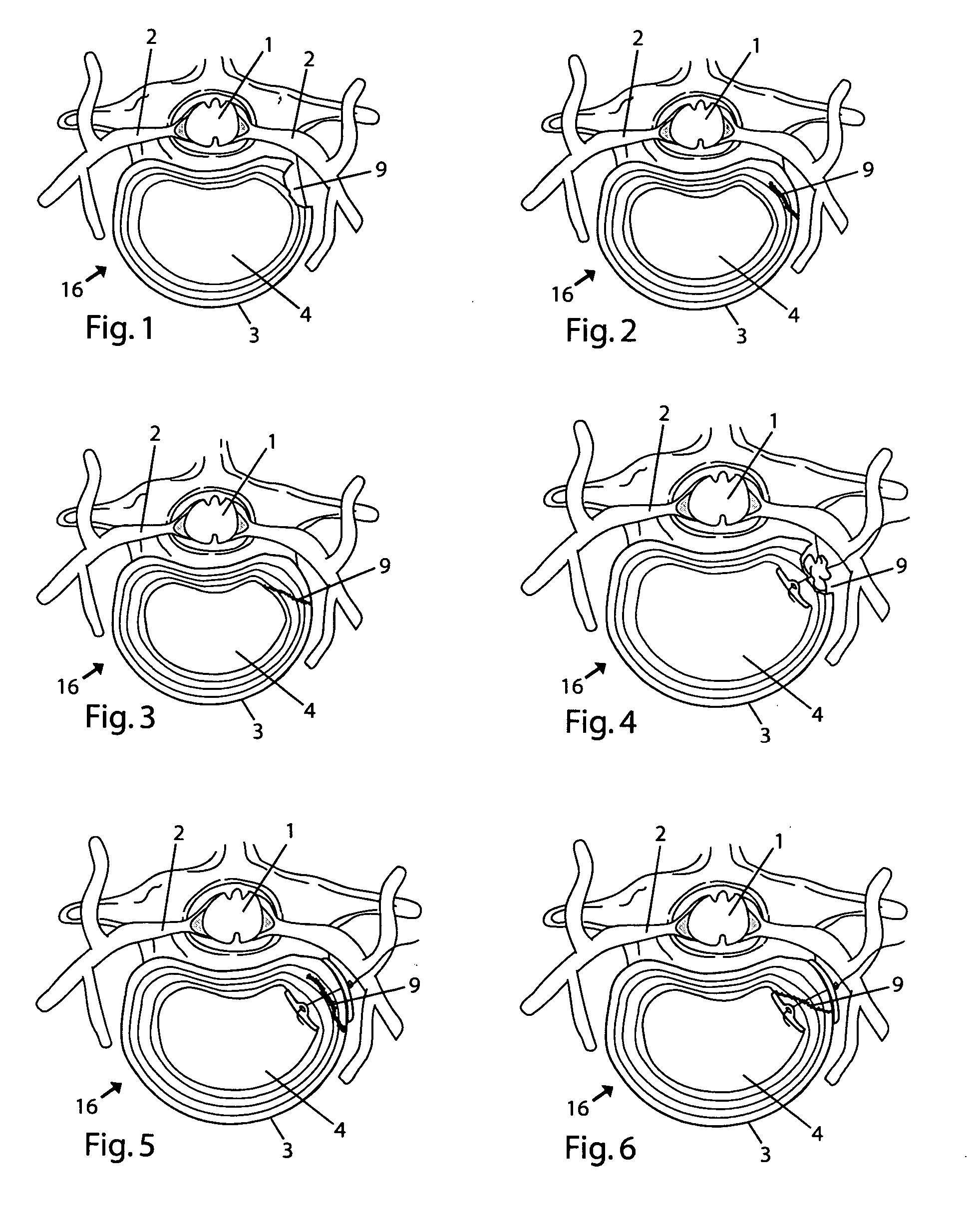 System and devices for the repair of a vertebral disc defect