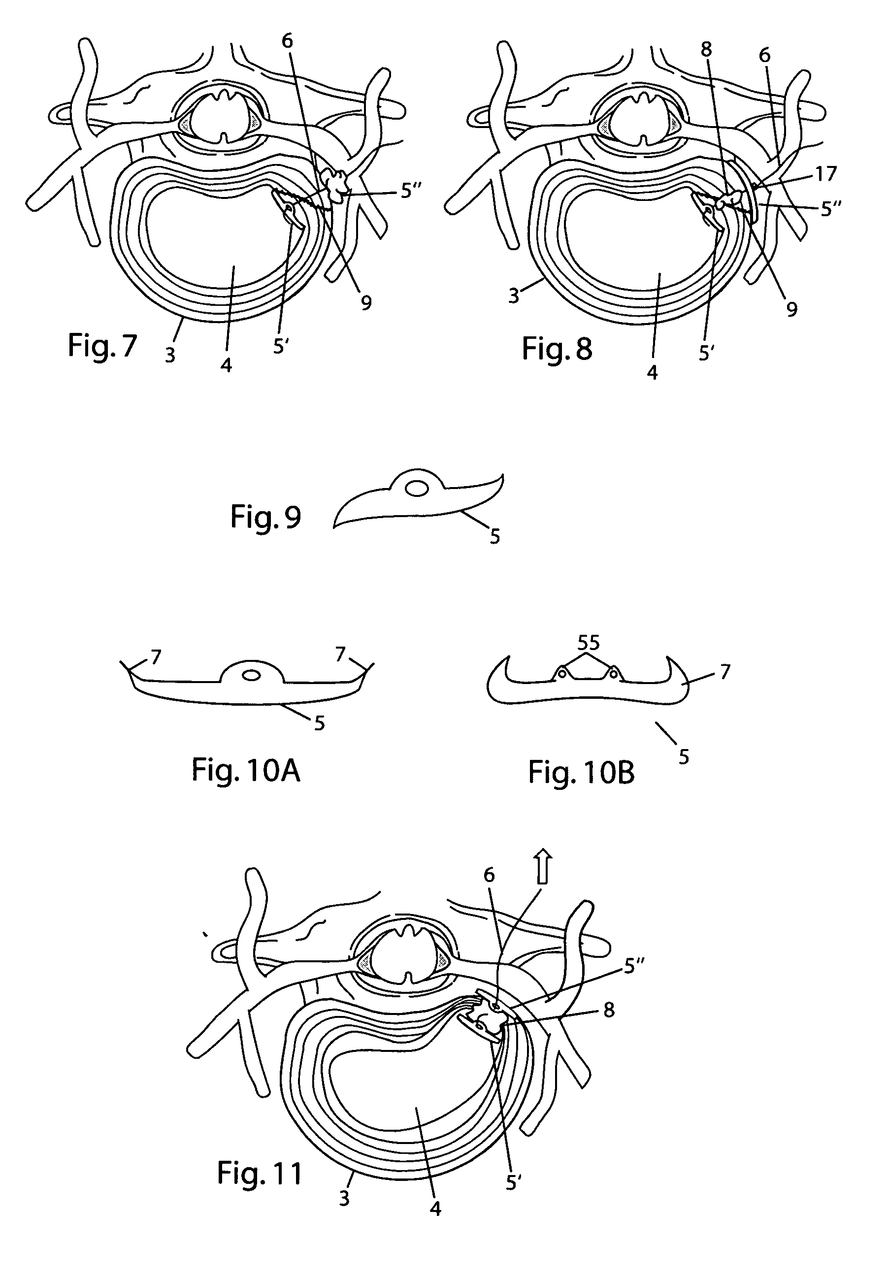 System and devices for the repair of a vertebral disc defect