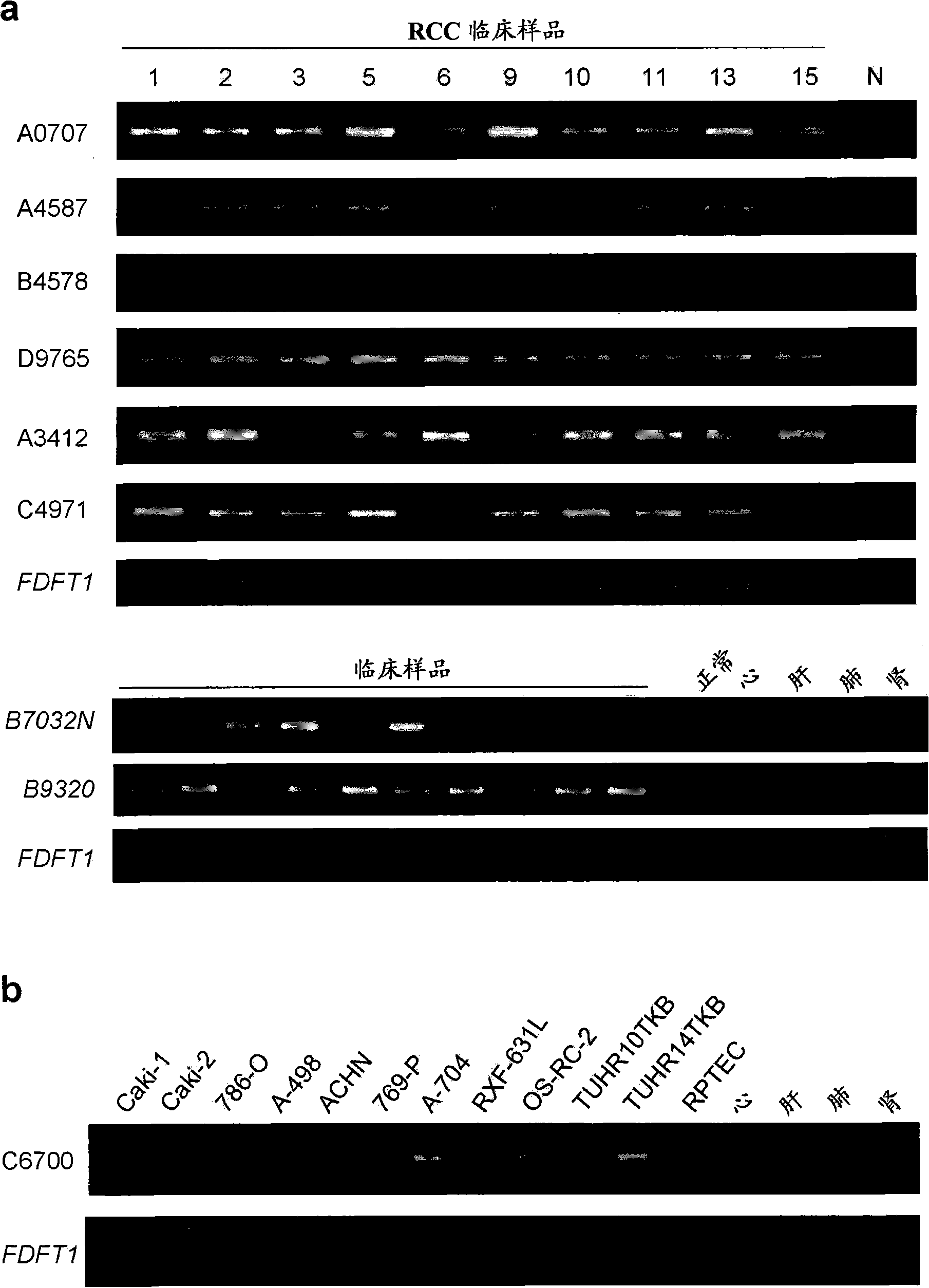 Method for diagnosing and treating renal cell carcinoma