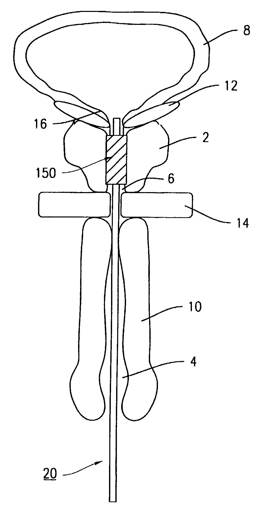 Urethral catheter stent delivery system