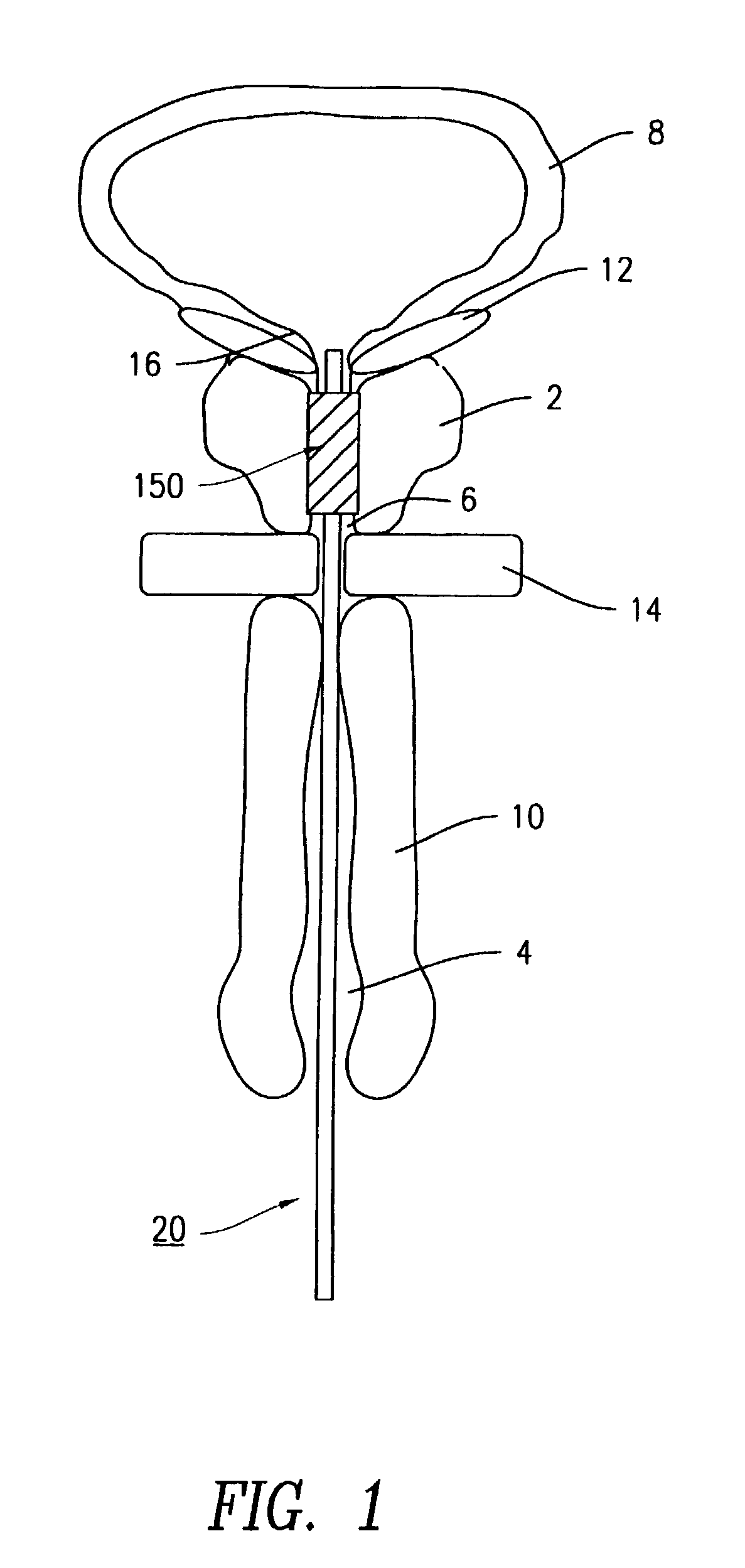 Urethral catheter stent delivery system