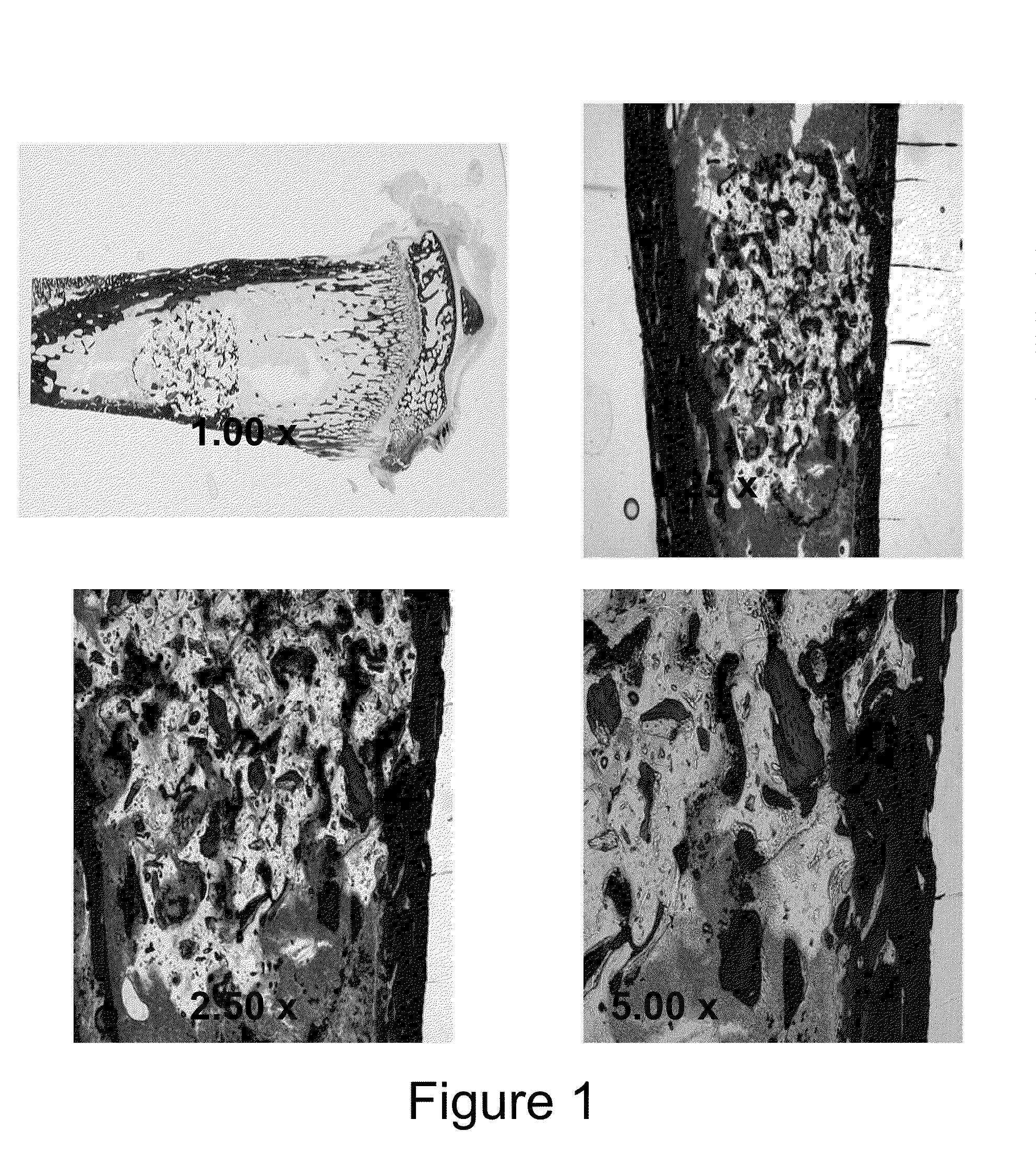 Injectable bone/polymer composite bone void fillers