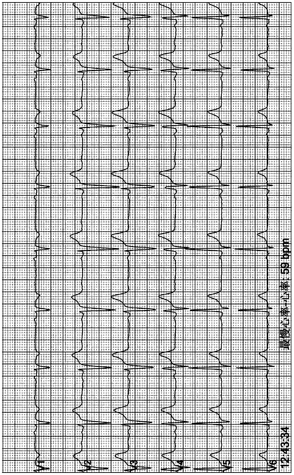 Light-cured cross-linked conductive hydrogel as well as preparation method and application thereof