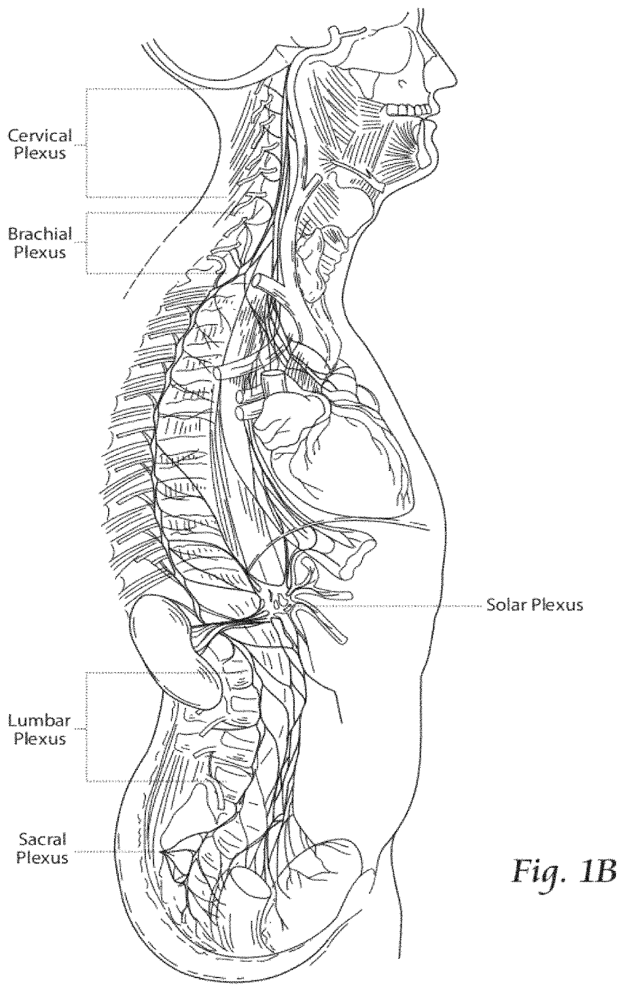 Systems and methods to place one or more leads in tissue to electrically stimulate nerves to treat pain