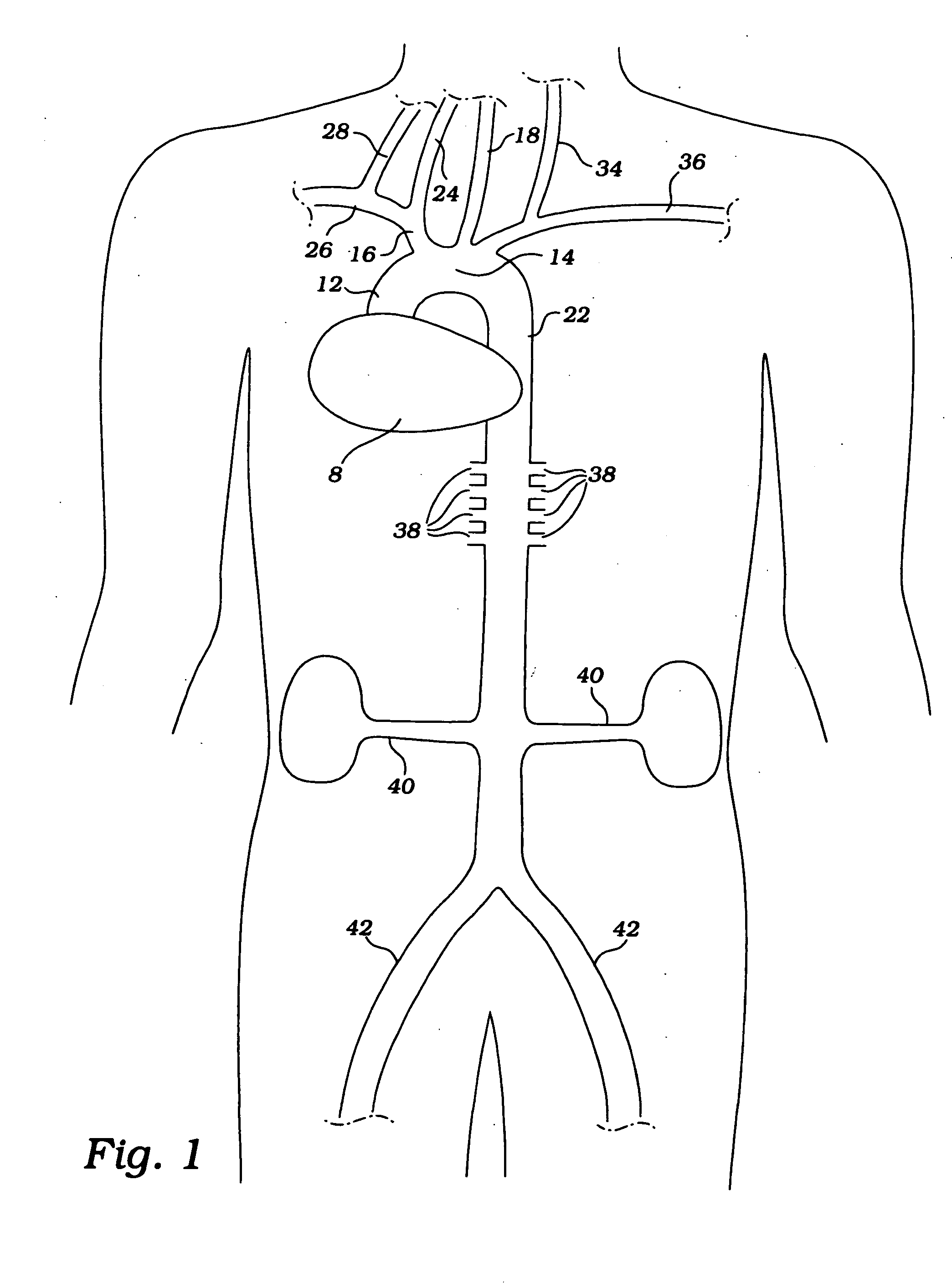 Cerebral perfusion augmentation