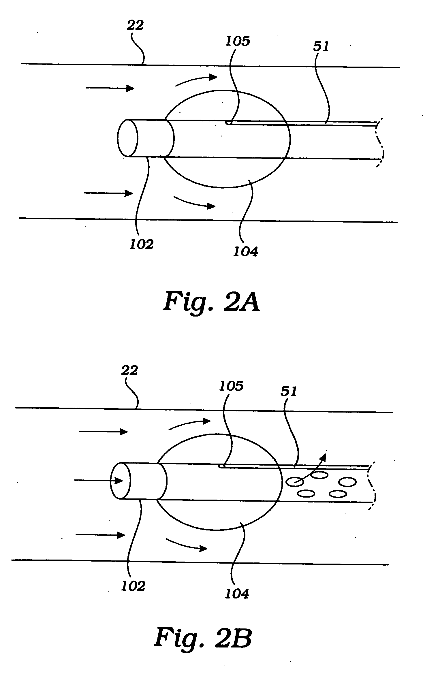 Cerebral perfusion augmentation