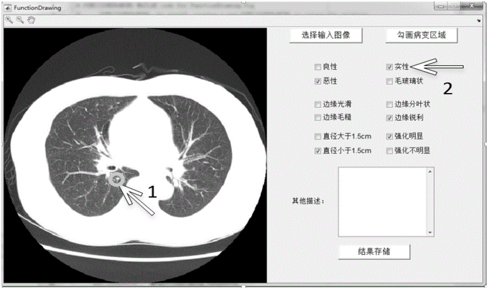 Method of automatically detecting and sketching pulmonary nodule positions based on convolution classifier